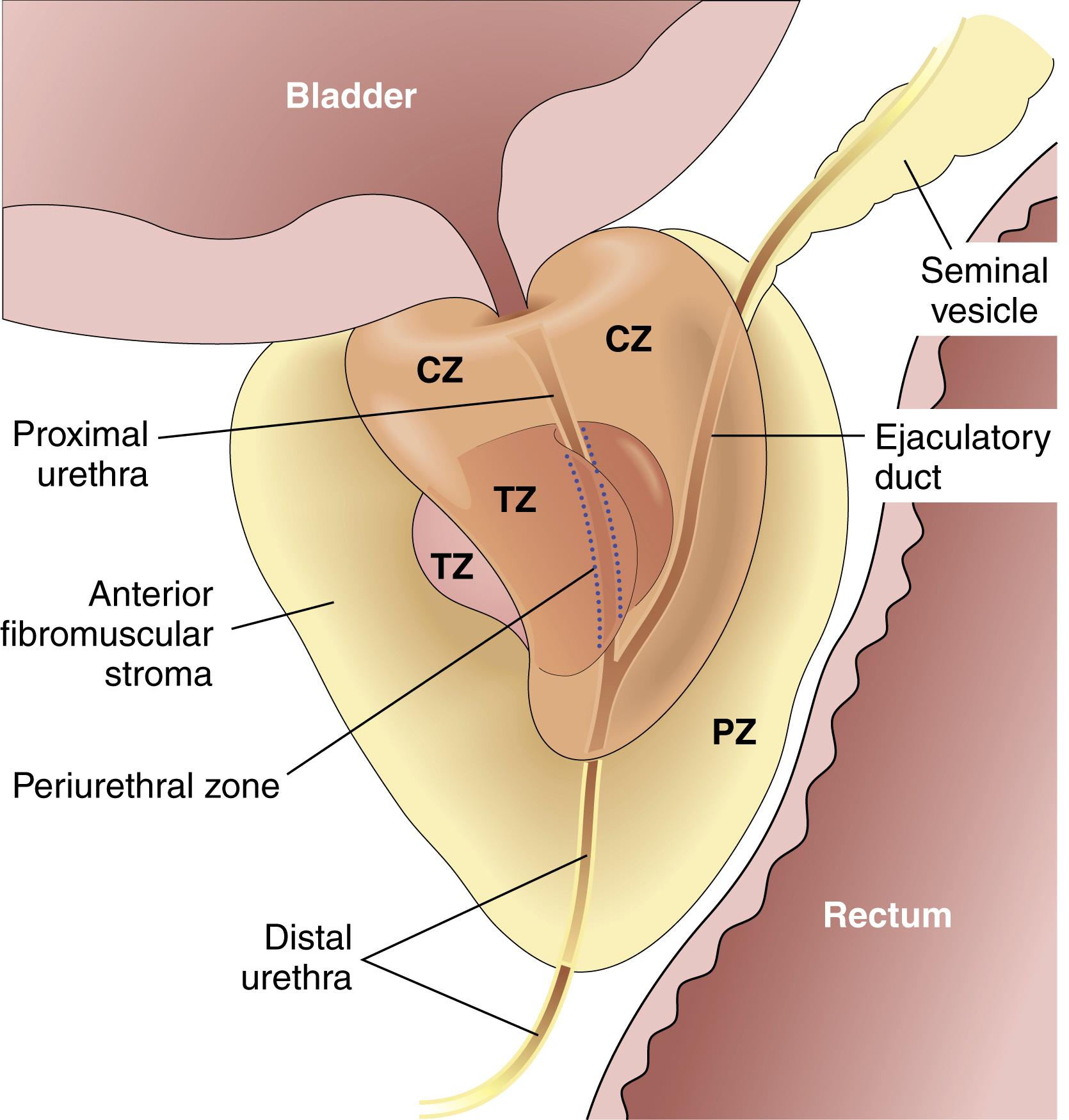 FIG. 16.10, Adult prostate. The normal prostate contains several distinct regions, including a central zone (CZ), a peripheral zone (PZ), a transitional zone (TZ), and a periurethral zone. Most carcinomas arise from the peripheral glands of the organ, whereas nodular hyperplasia arises from more centrally situated glands.