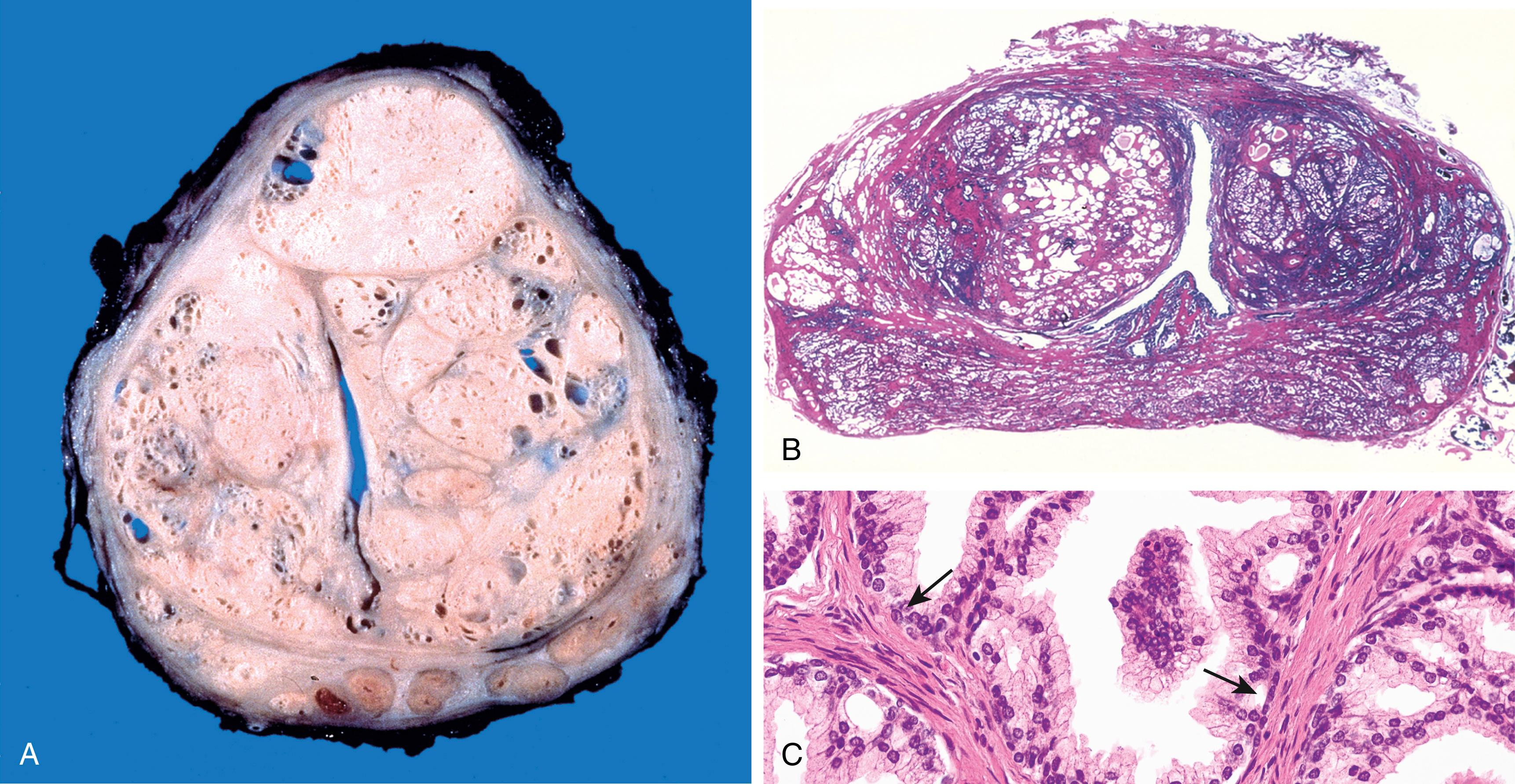 FIG. 16.11, Benign prostatic hyperplasia (BPH). (A) Well-defined nodules of BPH compress the urethra into a slitlike lumen. (B) Low-power photomicrograph demonstrates nodules of hyperplastic glands on both sides of the urethra. In other cases of nodular hyperplasia, the nodularity is caused predominantly by stromal, rather than glandular, proliferation. (C) Higher-power photomicrograph demonstrates the morphology of the hyperplastic glands, which are large and have papillary infoldings. Unlike prostatic adenocarcinoma, basal cells are present (arrows) .