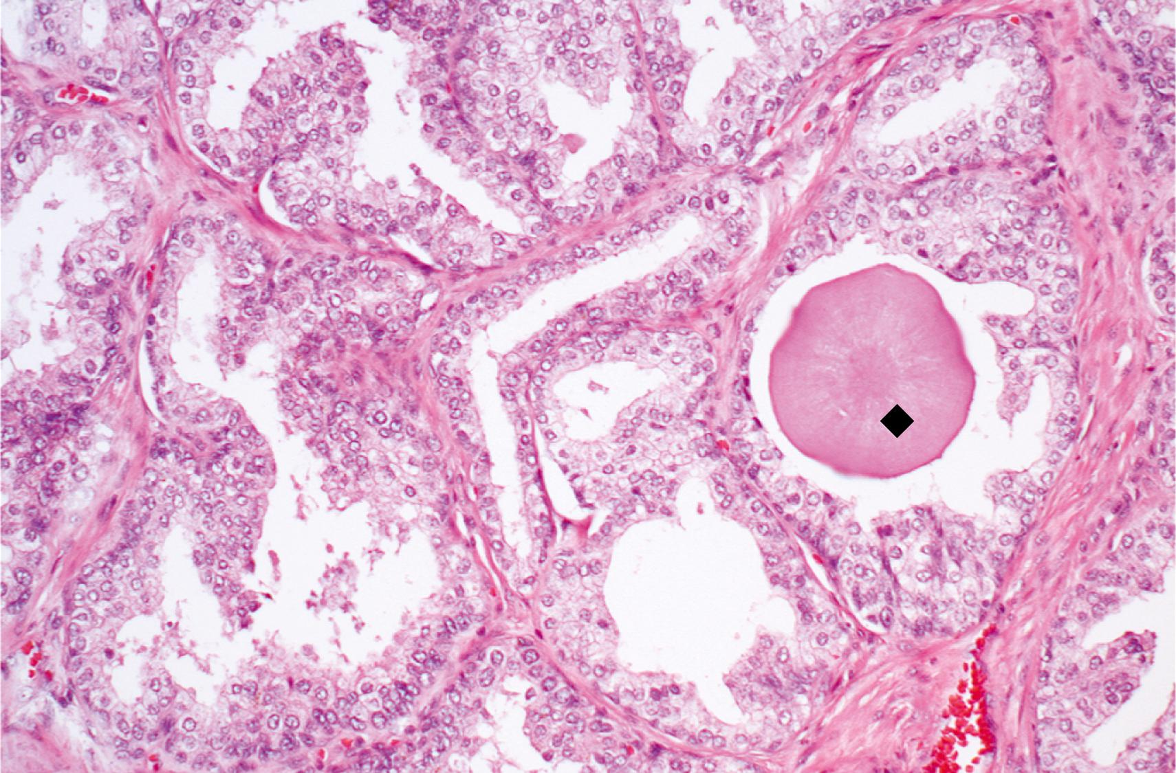 eFIG. 16.3, Benign prostatic hyperplasia with a rounded pink concretion (black diamond) typical of corpora amylacea.