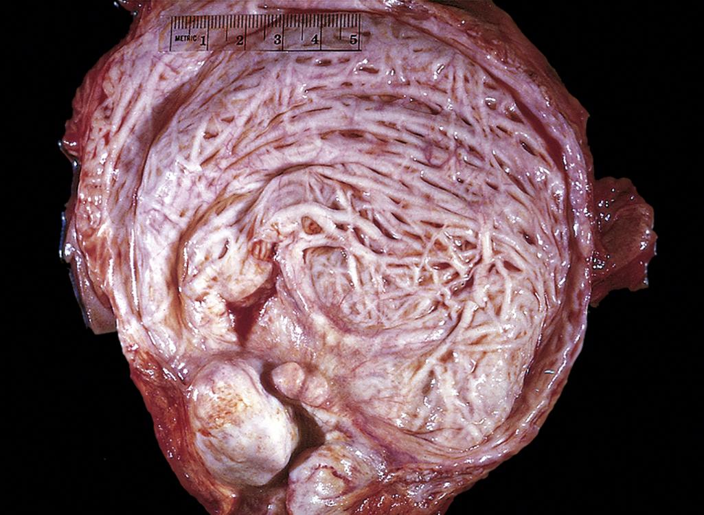 eFIG. 16.4, Hypertrophy and trabeculation of bladder wall secondary to benign prostatic hyperplasia.