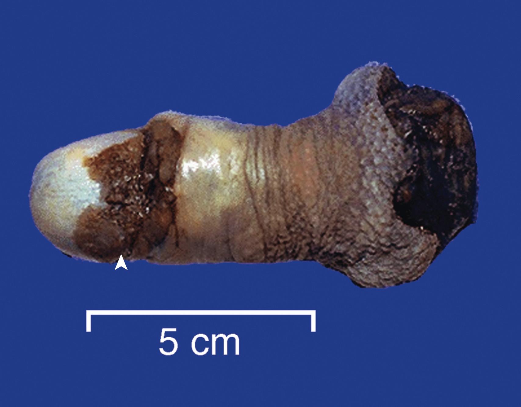 FIG. 16.2, Carcinoma of the penis. The glans penis is deformed by an ulcerated, infiltrative mass.
