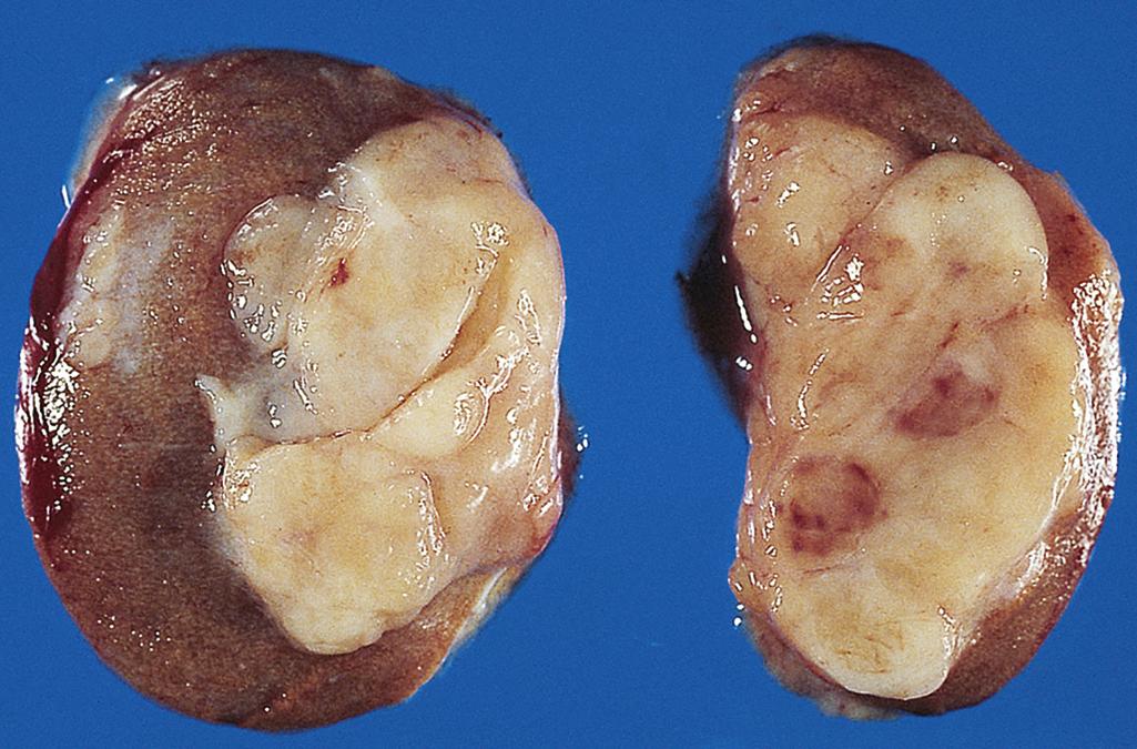 FIG. 16.3, Seminoma of the testis appearing as a well-circumscribed, pale, fleshy, homogeneous mass.