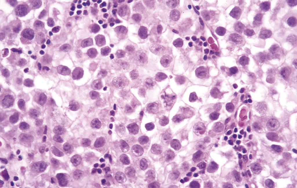 FIG. 16.4, Seminoma of the testis. Microscopic examination reveals large cells with distinct cell borders, pale nuclei, prominent nucleoli, and a sparse lymphocytic infiltrate.