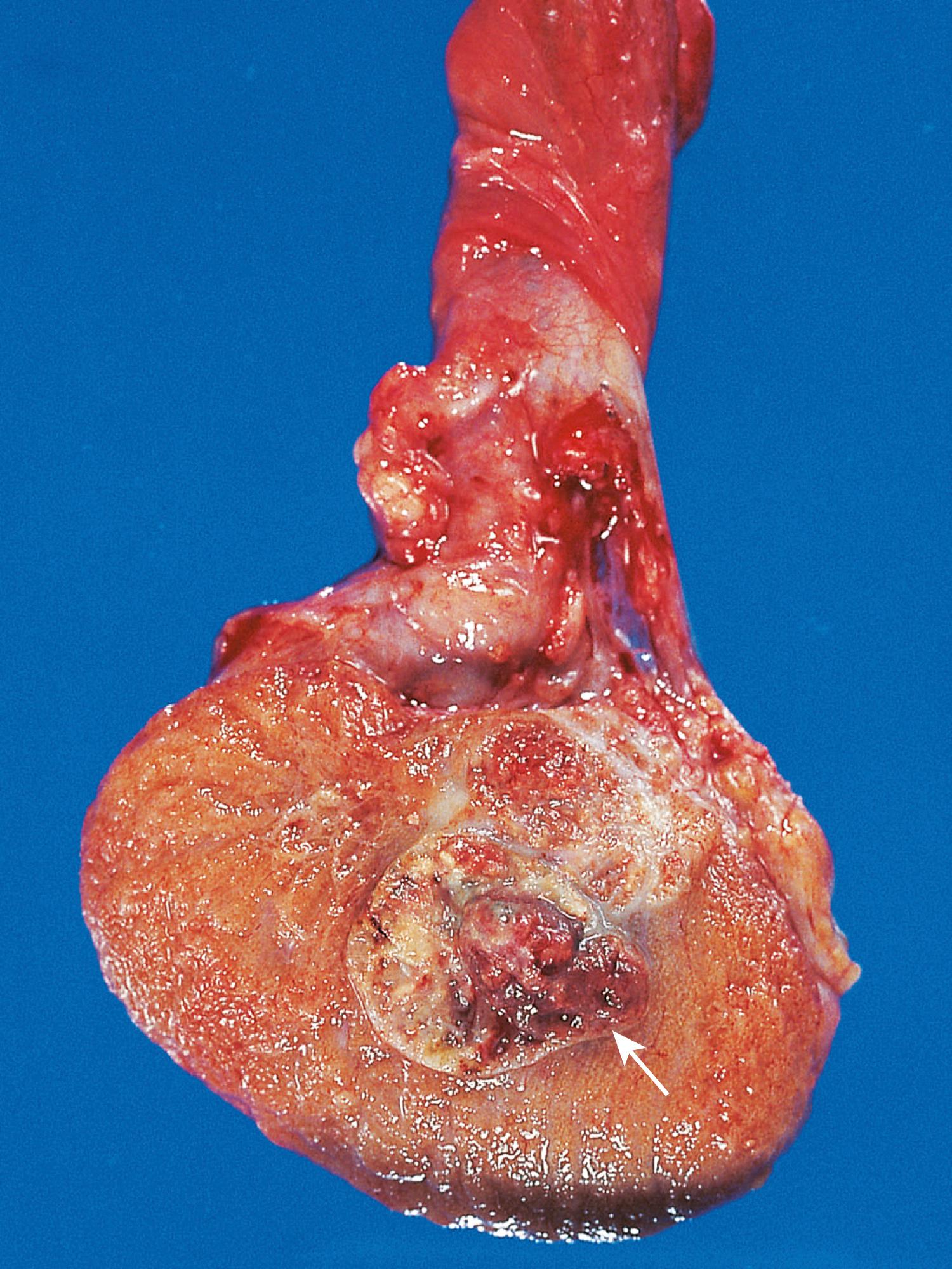 FIG. 16.5, Embryonal carcinoma. In contrast with the seminoma in Fig. 16.3, this tumor is hemorrhagic (arrow) .