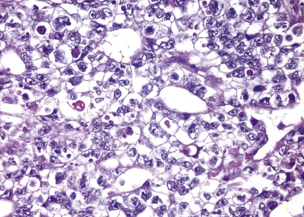 FIG. 16.6, Embryonal carcinoma. Note the sheets of undifferentiated cells and primitive glandlike structures. The nuclei are large and hyperchromatic.