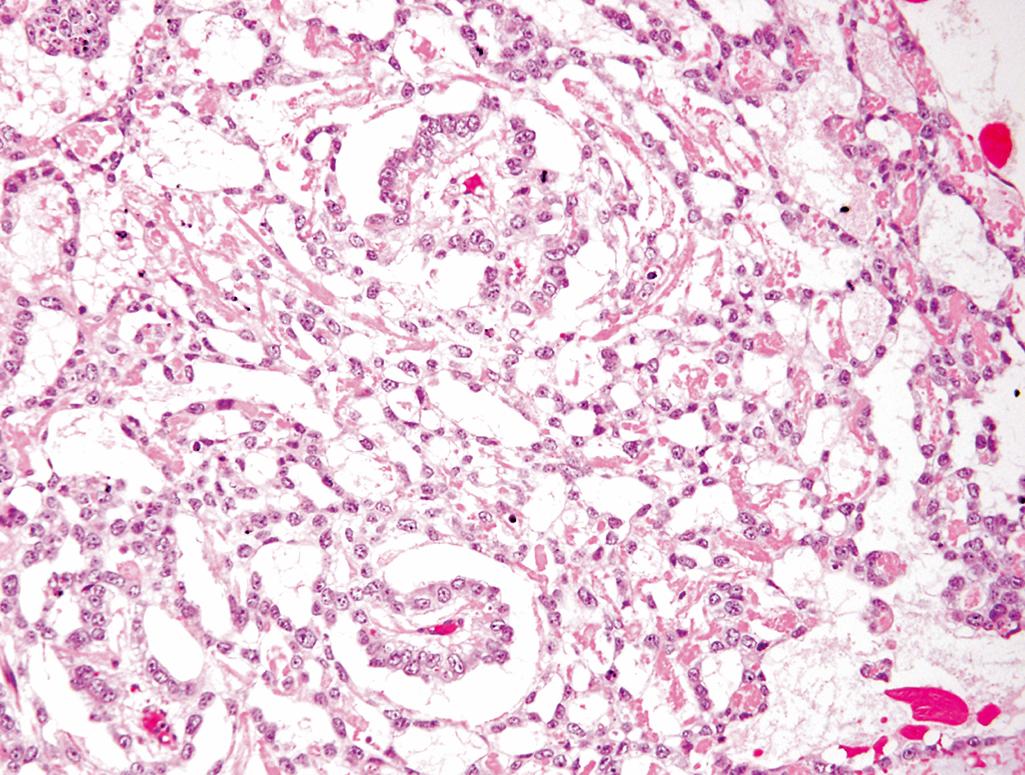 FIG. 16.7, Yolk sac tumor demonstrating areas of loosely textured, microcystic tissue and papillary structures resembling a developing glomerulus (Schiller-Duval bodies).