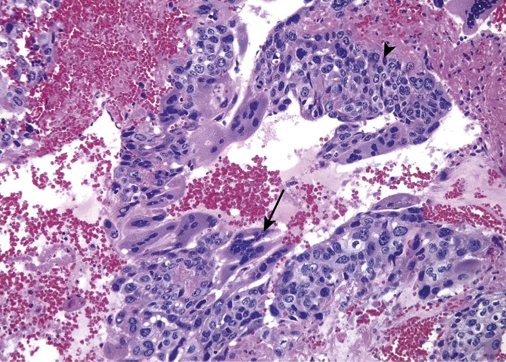 FIG. 16.8, Choriocarcinoma. Both cytotrophoblastic cells with single central nuclei (arrowhead, upper-right) and syncytiotrophoblastic cells with multiple dark nuclei embedded in eosinophilic cytoplasm (arrow, middle) are present. Hemorrhage and necrosis are prominent.