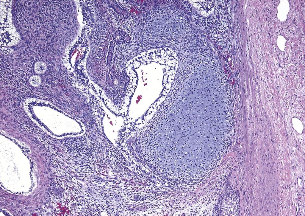 FIG. 16.9, Teratoma of the testis, consisting of a disorganized collection of glands, cartilage, smooth muscle, and immature stroma.