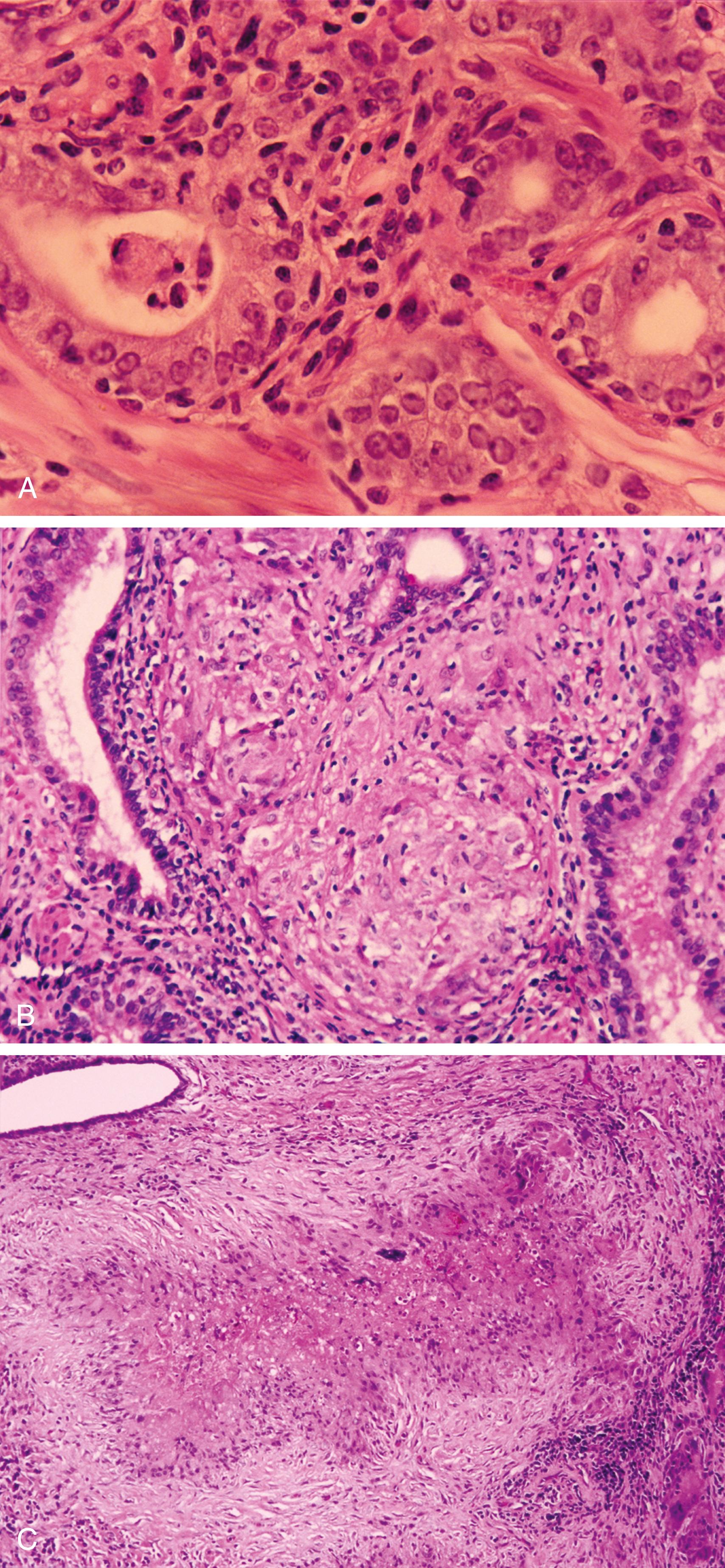 Figure 11.1, A, Chronic, focally acute prostatitis. Note the presence of reactive atypicality of the acinar epithelium in the form of conspicuous nucleoli. B, Iatrogenic granulomatous prostatitis. Noncaseating epithelioid granulomas and associated lymphocytic infiltrate in a patient receiving bacillus Calmette-Guérin therapy for urothelial cancer. C, Iatrogenic granulomatous prostatitis. Low-power view of palisading histiocytes after transurethral resection. Note the atrophic-appearing prostatic gland (top left) .