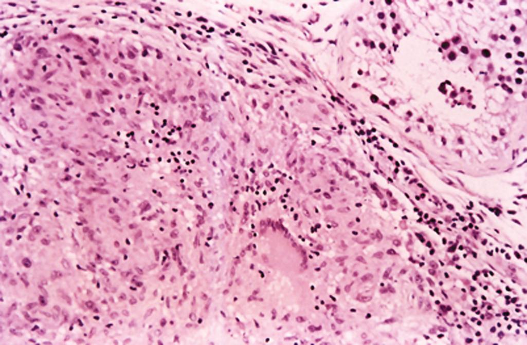 Figure 11.12, Idiopathic granulomatous orchitis.