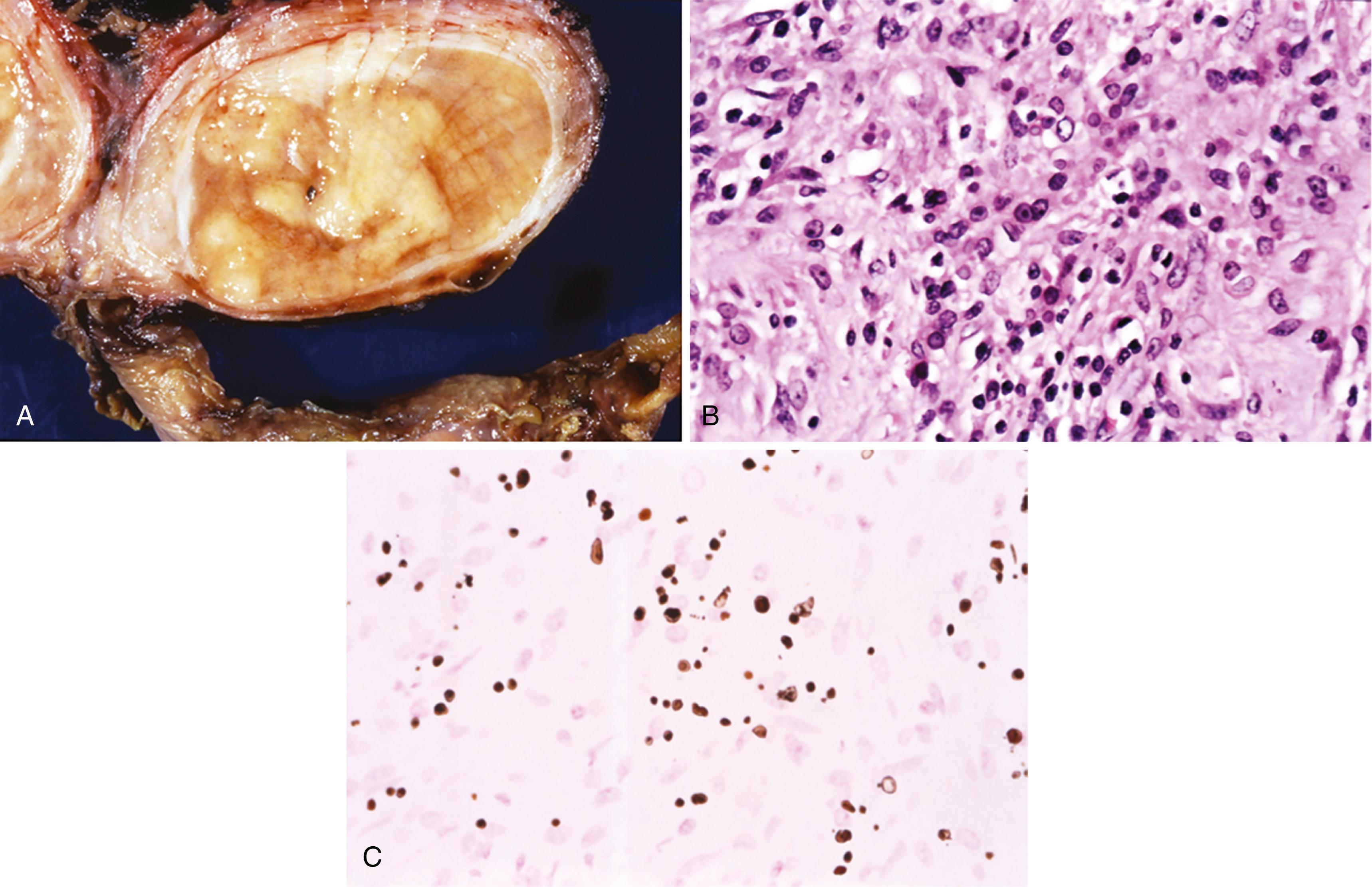 Figure 11.13, Testicular malakoplakia.