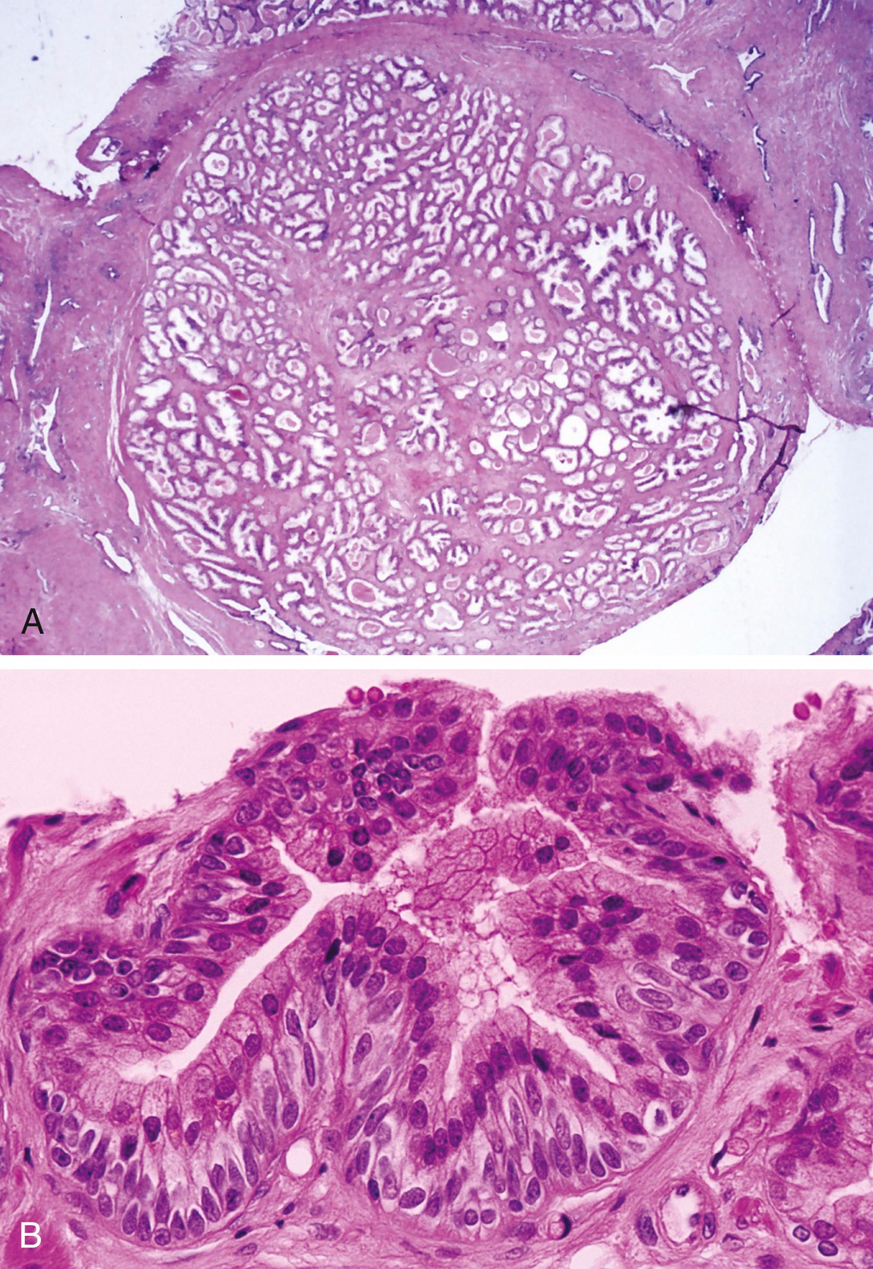 Figure 11.3, A, Benign (nodular) prostatic hyperplasia. Low-power view of a gland-rich hyperplastic nodule. Other nodules (not shown) may be stroma rich. B, Basal cell hyperplasia (BCH). Subluminal cell proliferation of basal cells characterized by elongated nuclei, longitudinal nuclear grooves, conspicuous nucleoli, and amphophilic cytoplasm. BCH showing enlarged nucleoli (atypical BCH) should not be confused with high-grade prostatic intraepithelial neoplasia.