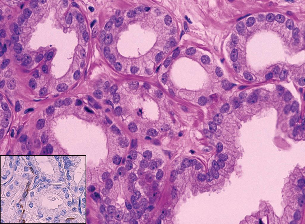 Figure 11.4, Prostatic intraepithelial neoplasia, high grade, flat type. Back-to-back glands lined by a single layer of epithelial cells with prominent nucleoli. Note the presence of attenuated basal cells ( inset ; high-molecular-weight cytokeratin immunohistochemical stain).