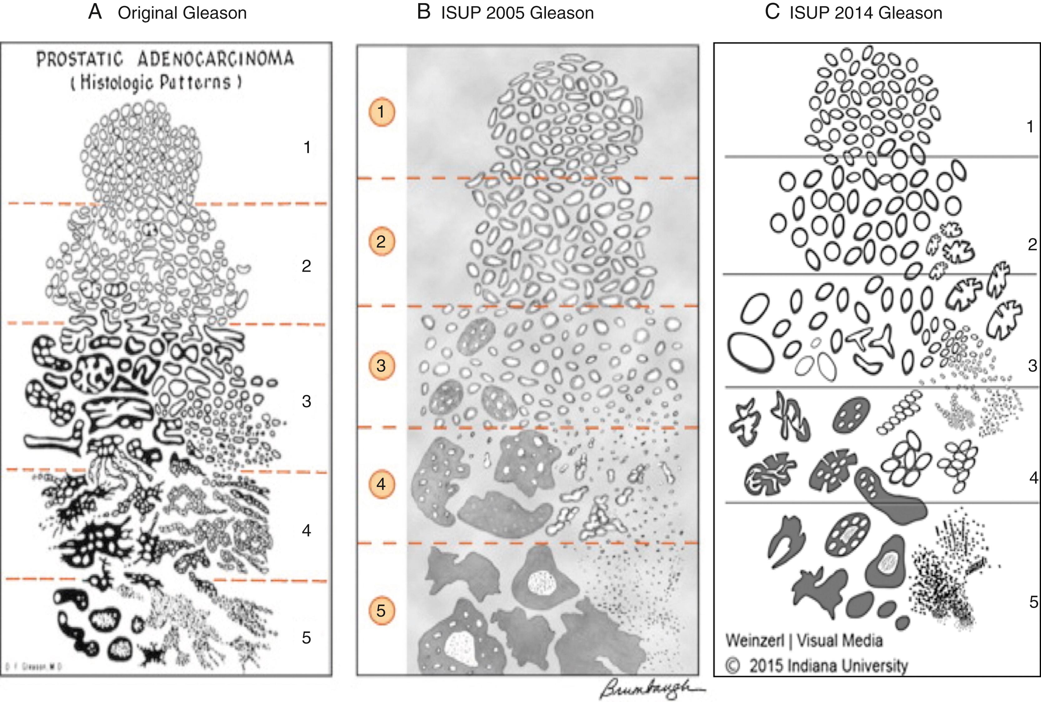 Figure 11.6, The Gleason grading system has evolved (see above) and continues to evolve with ongoing debate over nuances. The system remains primarily based on architecture with tumors able to form glands (well differentiated) and tumors unable to form glands (poorly differentiated) at the low and high ends of the Gleason grade spectrum, respectively. A, Original Gleason. B, International Society of Urological Pathology (ISUP) 2005 Gleason. C, ISUP 2014 Gleason.