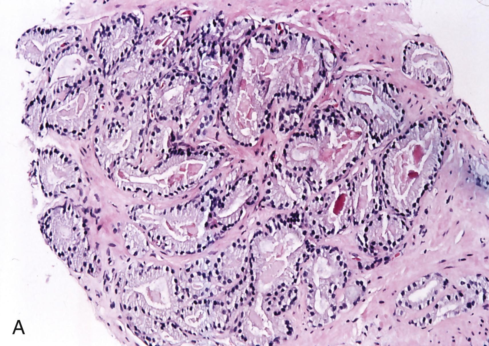 Figure 11.5, A, Prostatic adenocarcinoma on needle core. Gleason score 3 + 2: pattern 3 based on variability in the size of the acini, and pattern 2 based on good circumscription. B, Histopathologic findings pathognomonic for prostatic adenocarcinoma. Circumferential perineural invasion (top left) , extraprostatic invasion (top right) , glomeruloid bodies (bottom left) , and mucinous fibroplasia and collagenolysis (bottom right) . C, Variants of prostatic adenocarcinoma. Ductal type showing tall columnar cells with marked nucleomegaly and nucleolomegaly (top left) , neuroendocrine carcinoma in a patient with a history of treated acinar-type adenocarcinoma (top right) , signet ring cell type with individual cells diffusely infiltrating (bottom left) , and mucinous type with intraluminal and interstitial mucin (bottom right) .