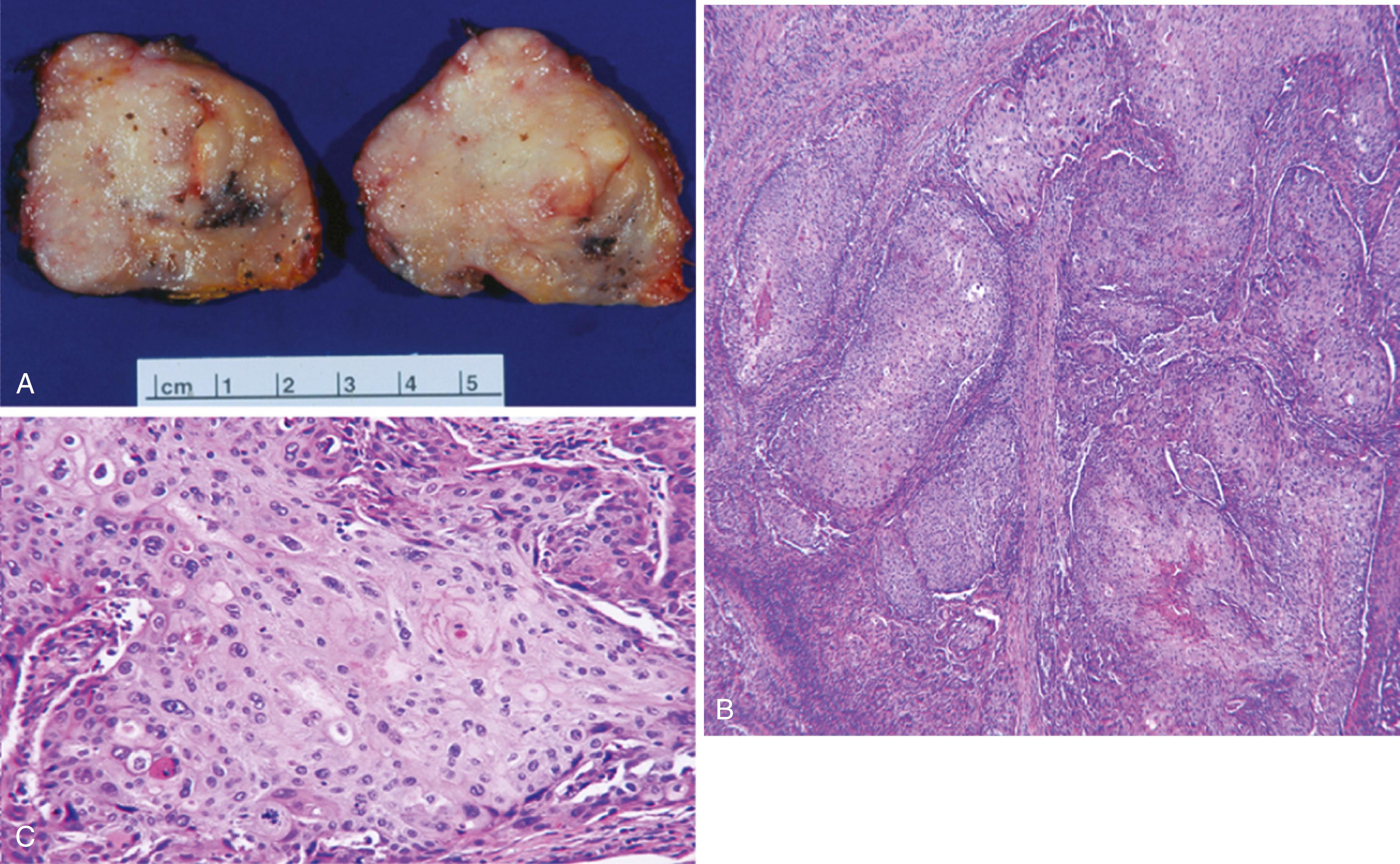 Figure 11.8, Primary squamous cell carcinoma of the prostate.