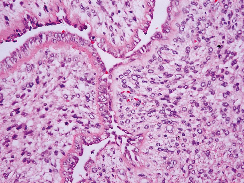 Figure 11.9, Prostatic phyllodes tumor.