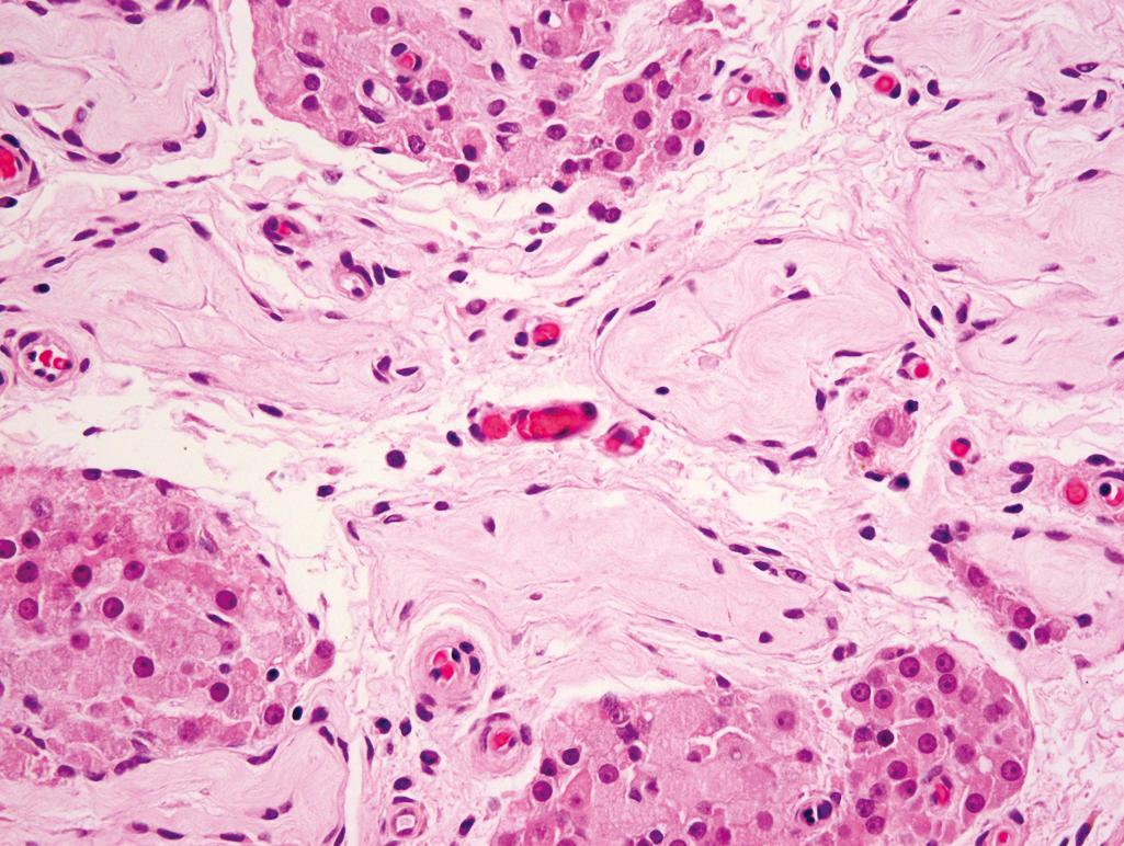 Figure 11.10, Cryptorchidism.