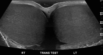 Fig. 22.2, Grayscale axial view of both testes. Observe a symmetrical appearance of both testes. This is an important view to note any differences in the appearance to the testes.