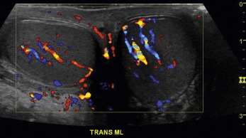 Fig. 22.3, Color Doppler view of both testes. Observe a fairly symmetrical perfusion of both testes. This is important to document in cases where there may be increased or decreased flow to one of the testes.