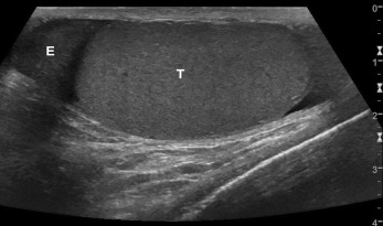 Fig. 22.4, Normal scrotal anatomy in an adult. Longitudinal ultrasound of the scrotum showing the homogeneous appearance to the testis ( T ) and the head of the epididymis ( E ).