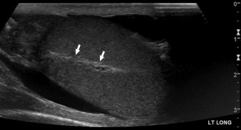 Fig. 22.5, Normal anatomy of the testis. The mediastinum of the testis ( arrows ) is where the rete testis converges and is seen as an echogenic band extending in a cranial-caudal direction.