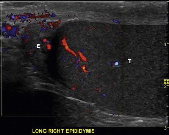 Fig. 22.6, Normal anatomy. Color Doppler. Color flow is identified in both normal testis ( T ) and epididymis ( E ).