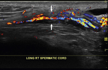 Fig. 22.7, Normal anatomy of the spermatic cord with color Doppler. The spermatic cord has smooth boundaries that are parallel ( arrows ). The cord includes the vas deferens, testicular artery, other arteries, the pampiniform plexus, lymphatics, and the ilioinguinal nerve.
