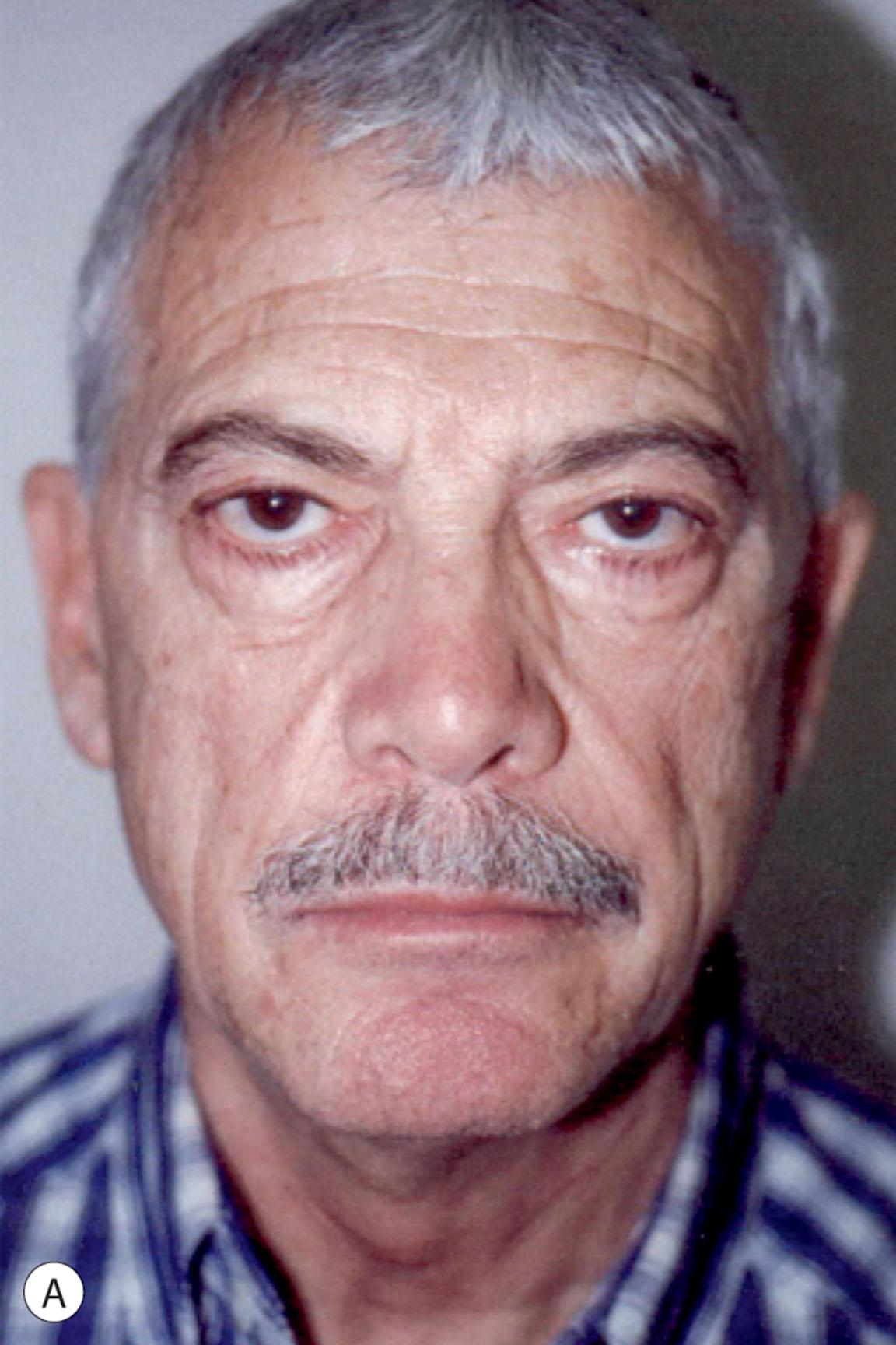 Figure 9.11.1, High SMAS facelift and related procedures in a male patient. (A) Before surgery view of patient, age 59. He can be seen to have combined surface aging of his skin, tissue sagging and redundancy, and facial atrophy. Note heavily wrinkled forehead, hollow cheeks and midface, deep cheek folds and sagging facial tissues. (B) Same patient, 1 year and 6 months after facelift, necklift, forehead lift, upper blepharoplasty with levator reinsertion, lower blepharoplasty, and partial facial fat grafting. Note improvement in forehead wrinkling, brow position, eye appearance, lower eyelid fullness, posture of perioral tissues, and overall facial sagging. Increased facial fullness following fat grafting is also evident particularly in the midface. The patient has a more rested, youthful, healthy, virile, and masculine appearance without a tight, pulled, or “facelifted” look. All surgical procedures performed by Timothy Marten, MD, FACS.