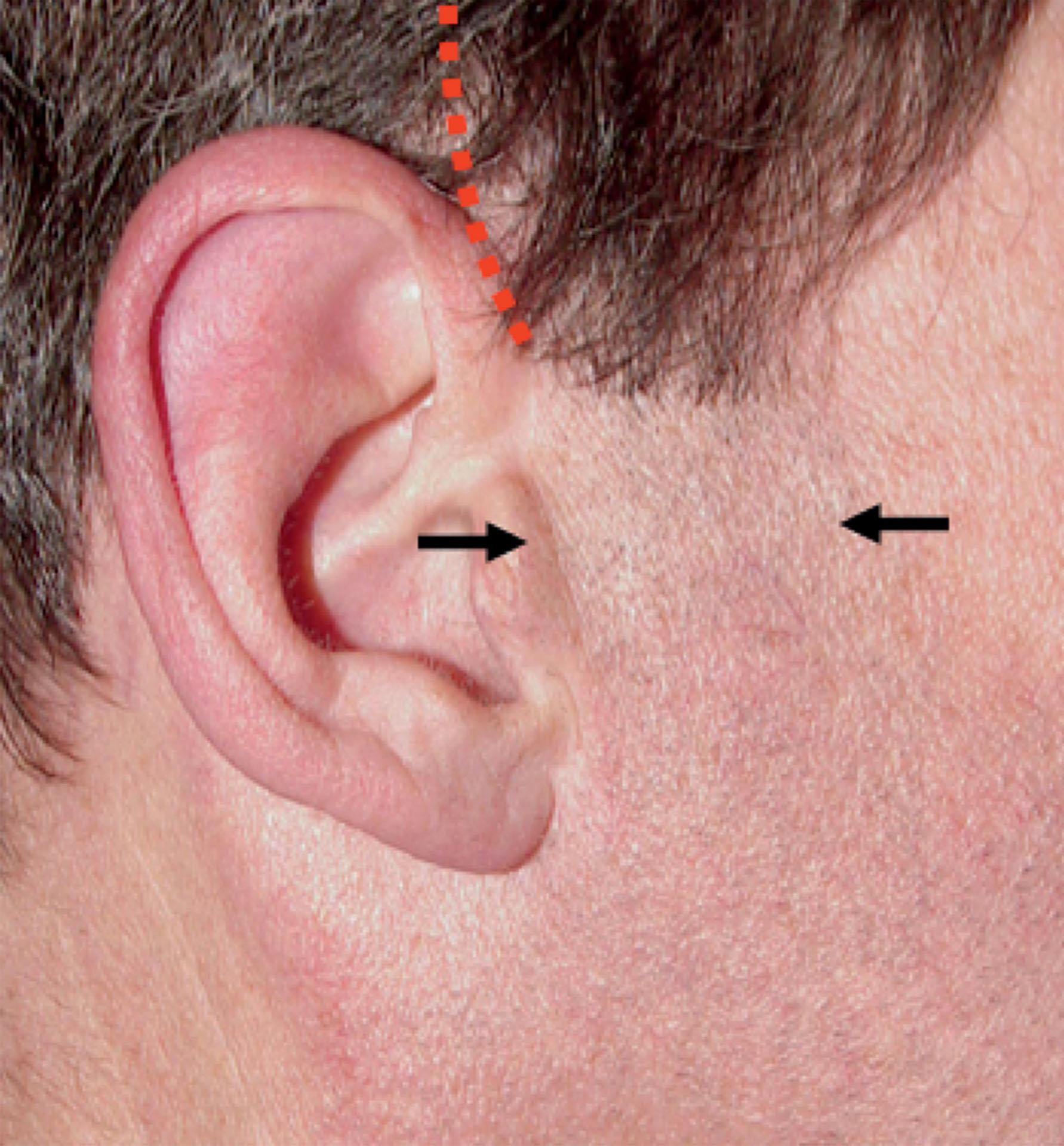 Figure 9.11.7, Temple scalp temporal incision plan. When cheek skin redundancy is small and abundant temple and sideburn hair is present, an incision hidden in the temple scalp (red dotted line) can be used without producing objectionable sideburn and temporal hairline displacement. Note sideburn and bearded skin in front of the ear (area between black arrows) have been moved posteriorly closer to the ear but not objectionably so (retrotragal pre-auricular incision plan has been used; (see Fig. 9.11.12 ). Procedure performed by Timothy Marten, MD, FACS.