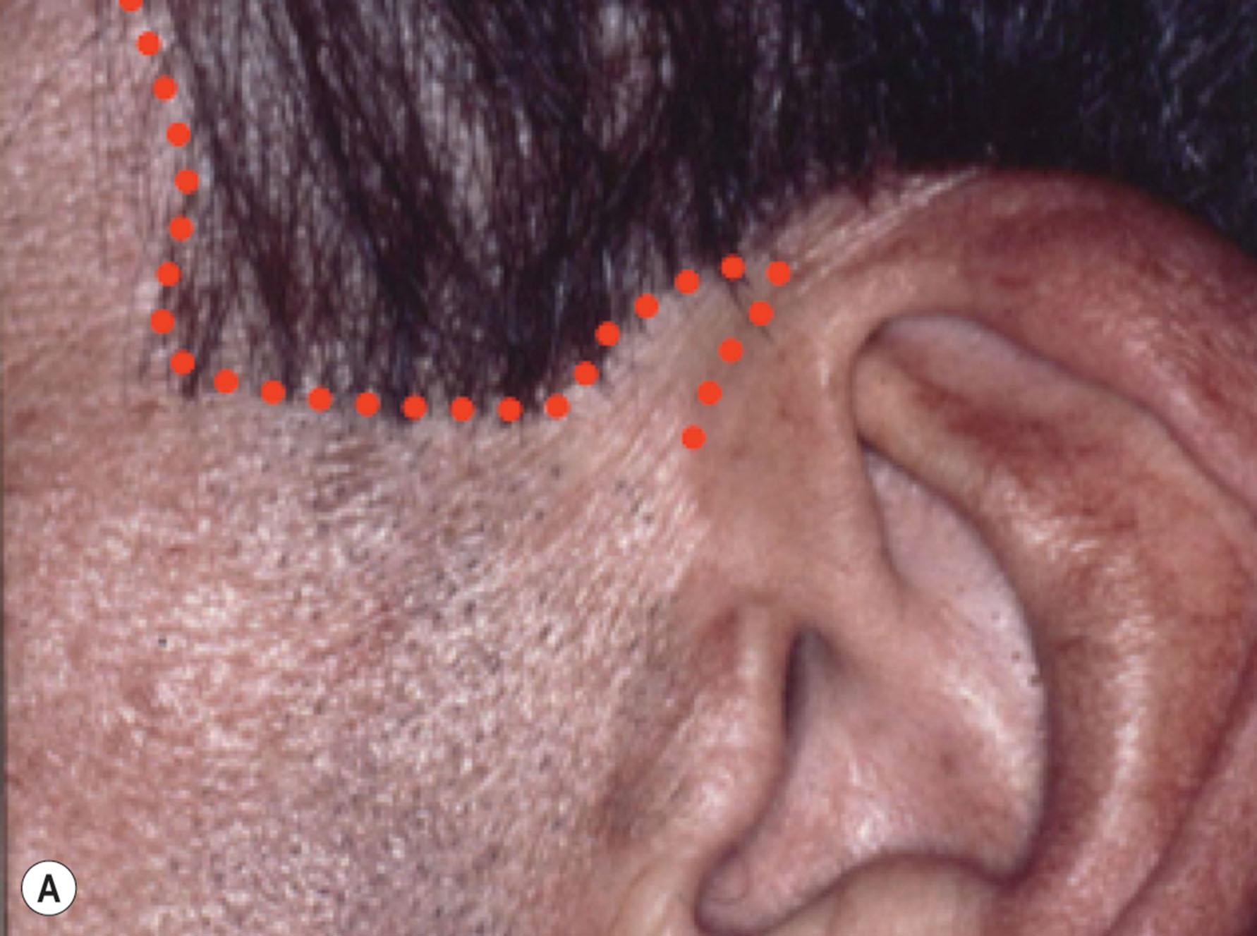 Figure 9.11.8, (A,B) Temporal hairline incision in the male patient. In many male patients skin shifts and the presence of sparse temple hair can result in unnatural, tell-tale, and effeminate-appearing displacement of the temporal hairline and sideburn if such a plan is used. Placing the incision along the hairline prevents this problem and results in a well-concealed scar if the incision is closed properly. (A) Plan for temple hairline incision in the male patient. Note that unlike the incision plan in a female patient that is made as a soft curve, the incision in men should be planned in a more angular fashion, echoing the shape of the male sideburn. (B) Close-up of healed incision. Hairline displacement has been avoided and the scar is well concealed. The sideburn has an angular masculine shape and has not been retrodisplaced or diminished in size (note slight shift of bearded skin below the sideburn can be seen). Surgical procedures performed by Timothy Marten, MD, FACS.