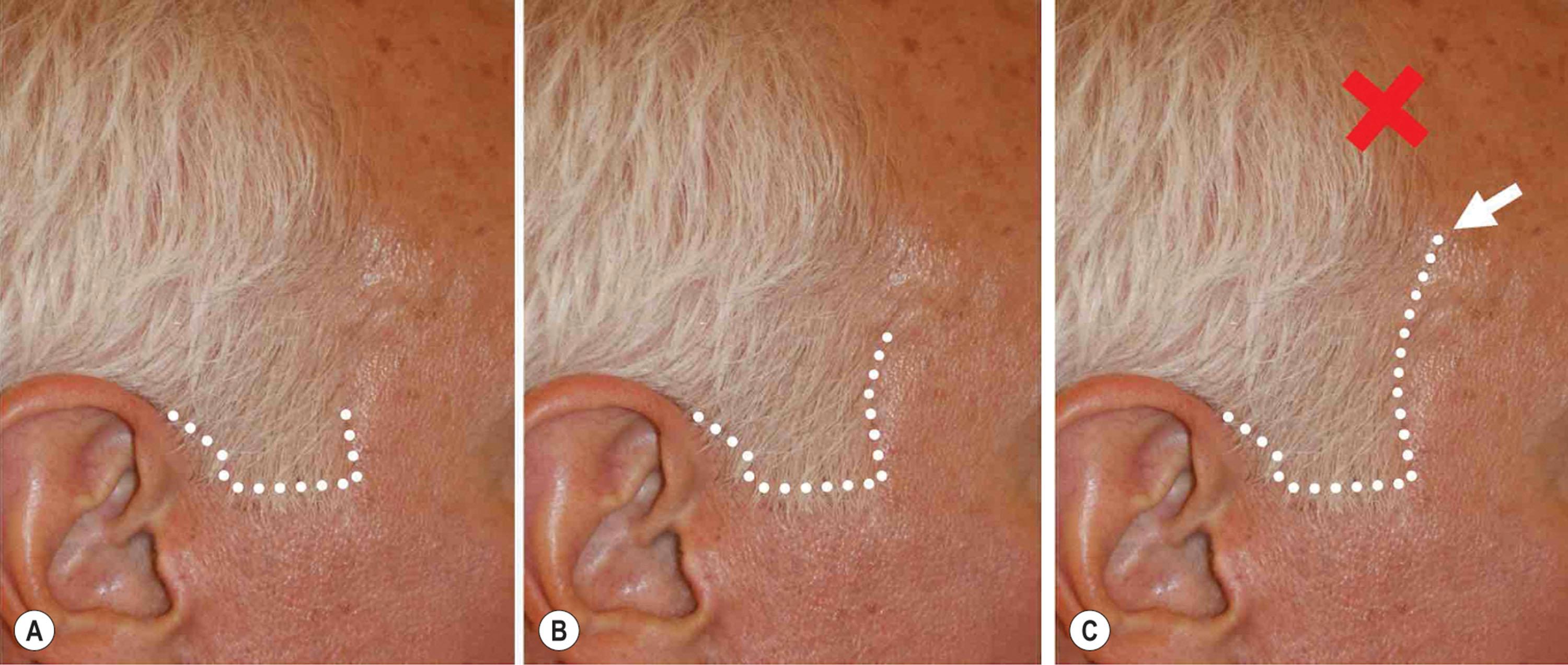 Figure 9.11.9, (A–C) Length of the temple hairline incision. The superior extent of the temporal hairline incision will vary depending upon the amount of cheek skin shift predicted (and whether a forehead lift is to be concomitantly performed) if puckering and gathering is to be avoided in this area. (A) Superior extent of temple hairline incision when modest cheek skin displacement is predicted (white dotted line). (B) Superior extent of temple hairline incision when moderate cheek skin displacement is predicted (white dotted line). The incision must be made higher to accommodate the cheek skin shift, but still is situated in a well-concealed location. (C) Superior extent of temple hairline incision when large cheek skin displacement is predicted (white dotted line). This incision should be made no higher than the junction of the temporal hairline with the frontotemporal hairline, however (point shown by white arrow). If it is carried more superiorly along the frontotemporal hairline (area designated by red X) the resulting scar will usually be visible as hair tends to grow posteriorly in that area. Procedure performed by Timothy Marten, MD, FACS.