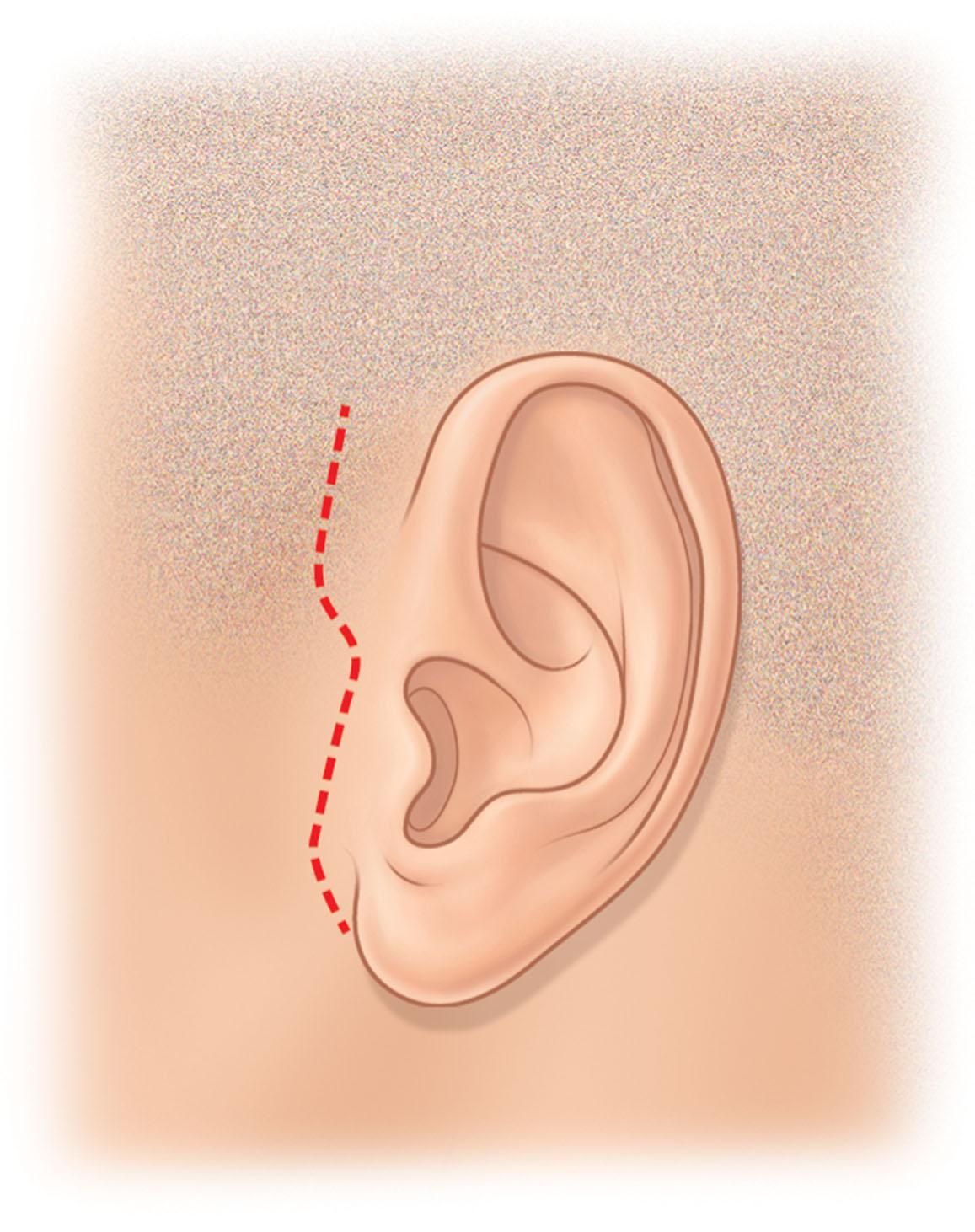 Figure 9.11.10, Traditional location of the pre-auricular incision. This places the scar in most men in an area open to inspection by others and “brands” the male patient as having had facelift surgery. Gradients of color and texture between smooth, pale auricular skin and coarse, red cheek skin draw additional attention to the scar (see Figs. 9.11.11A–C ).