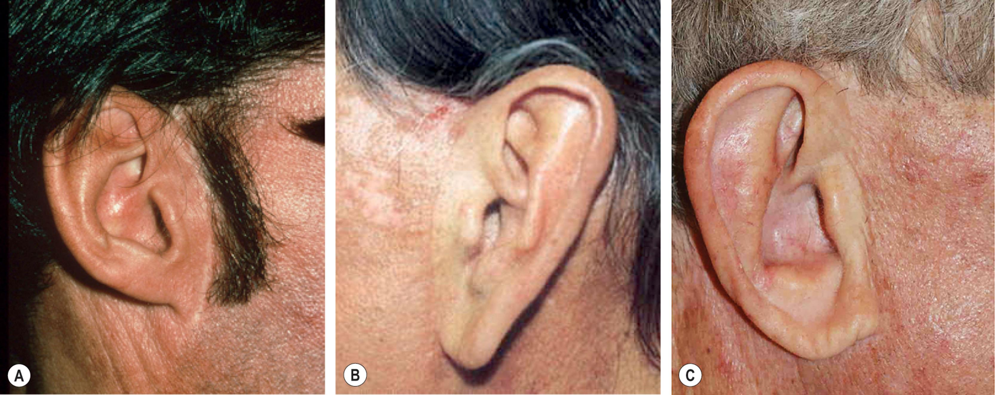 Figure 9.11.11, Typical irregularities seen when a pretragal incision is used in male patients. (A) An unknown surgeon has mistakenly tried to “hide” the pre-auricular incision along the posterior border of bearded skin. The scar is easily seen in the exposed location. A gradient of color and texture on each side of it draws additional attention to it, and the patient’s attempt to hide it by growing a long sideburn has failed. Retro-displacement of bearded skin against the scar has resulted in a thin, spindly, unnatural, and unmasculine-appearing sideburn. (B,C) An unknown surgeon failed to recognize the difference in color and texture of the ear (tragal) and cheek skin and the use of a pretragal incision has resulted in an obvious irregularity even though the scar itself is well healed. The difference in color and texture on each side of the scar would be better concealed along anatomic interfaces if a retrotragal (see Figs. 9.11.10–9.11.14 ) incision plan had been used. Procedures performed by unknown surgeons.