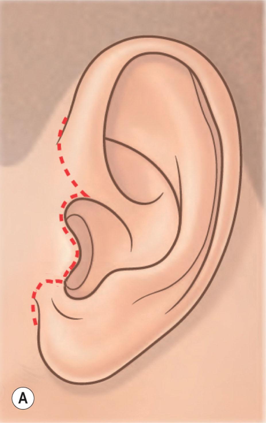 Figure 9.11.12, “Retrotragal” plan for the pre-auricular portion of the facelift incision. (A,B) Placing the incision along natural anatomic contours conceals the scar and disguises differences in color and skin texture on each side of it (see also Figs. 9.11.13 & 9.11.14 ).