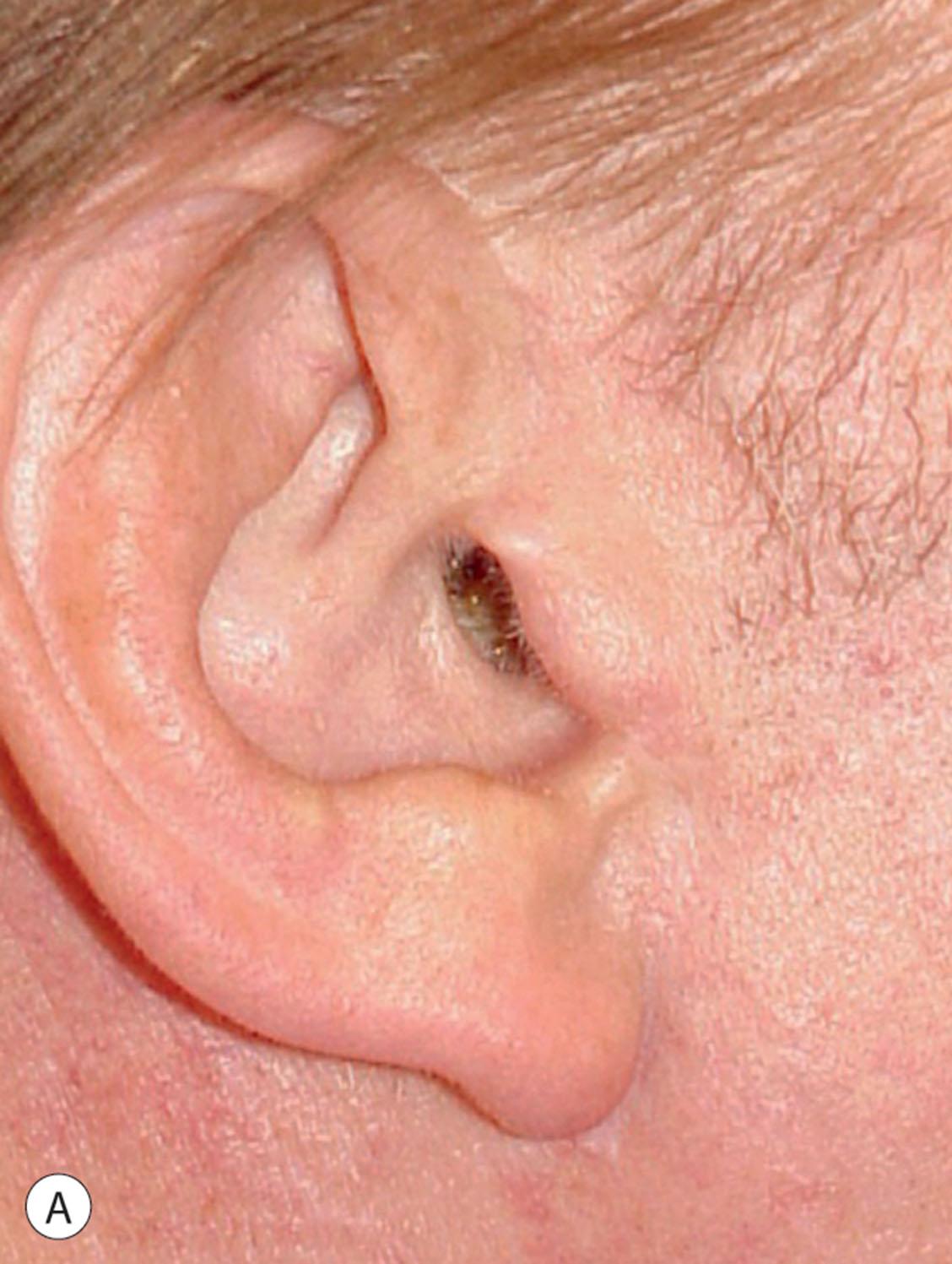 Figure 9.11.14, Healed “retrotragal” facelift scars in male patients. A retrotragal placement of the pre-auricular portion of the facelift incision has resulted in inconspicuous and well-concealed scars. In the upper third, the scar sits in the interface between the helix and the cheek and the scar appears to be a reflected highlight of the anterior helical border. In the middle third, the scar sits along the poster margin of the tragus and cannot be seen. Some coarse and bearded skin has been shifted up against and onto the tragus in (B) and (C), but this is less obvious than the presence of a pretragal scar with a gradient of color and texture on each side of it (see Fig. 9.11.11 ). In the lower third, the scar sits in a well-concealed location 2–3 mm outside the lobular-facial sulcus but far enough away from it that shaving in that area is not difficult. Note that the patient seen in (C) has a shaved head. All surgical procedures performed by Timothy Marten, MD, FACS.