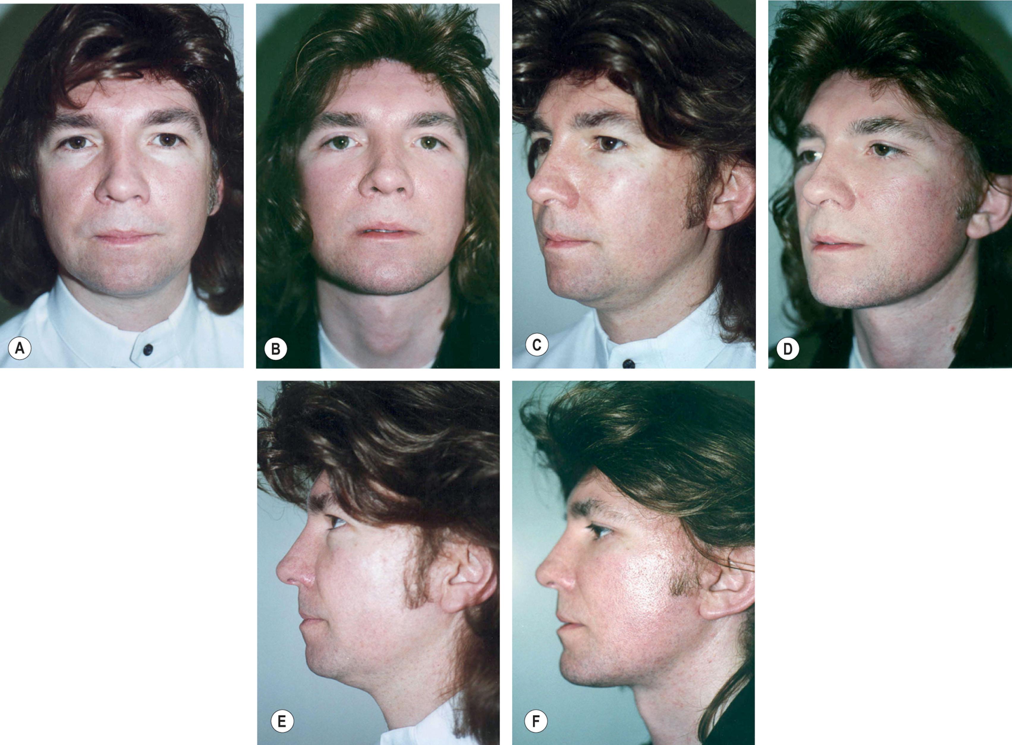 Figure 9.11.37, Patient Example 1. (A) Front view; before surgery view of patient, age 42. The patient has full upper eyelids, ptotic, hollow upper cheeks, cheek ptosis, and a weak appearing jawline. (B) Front view; same patient, 2 years and 3 months after facelift, necklift , small incision forehead lift, upper and lower eye lifts, fat grafting, and chin implant. Note corrections of hooded eyelids, improved cheek contour, and creation of a youthful and masculine facial shape without a tight or pulled appearance. (C) Oblique view; before surgery view of patient, age 42. Note hooded upper eyelid, sagging cheek, hollow lower orbit, and loss of youthful neck and jawline contour. (D) Oblique view; same patient, 2 years and 3 months after facelift, necklift , closed forehead lift, upper and lower eye lifts, fat grafting, and chin implant. Note softer appearance to eyes, improved cheek contours, masculine jawline, and improved neck contour. The chin contour is also improved and the patient has a rested, fit, athletic, decisive, and masculine appearance. (E) Lateral view; before surgery view of patient, age 42. Note lower eyelid fullness, infra-orbital atrophy, poor transition from the lower eyelid to the cheek, poor jawline, weak chin, and full neck. (F) Lateral view; same patient, 2 years and 3 months after facelift, necklift , closed forehead lift, upper and lower eye lifts, fat grafting, and chin implant. The transition from the lower eyelid to the cheek is improved, the cheek position has been improved, chin contour is improved and a fit, athletic, masculine-appearing jawline and neckline can be seen. The face has a natural appearance and all scars are well concealed. All surgical procedures performed by Timothy Marten, MD, FACS.