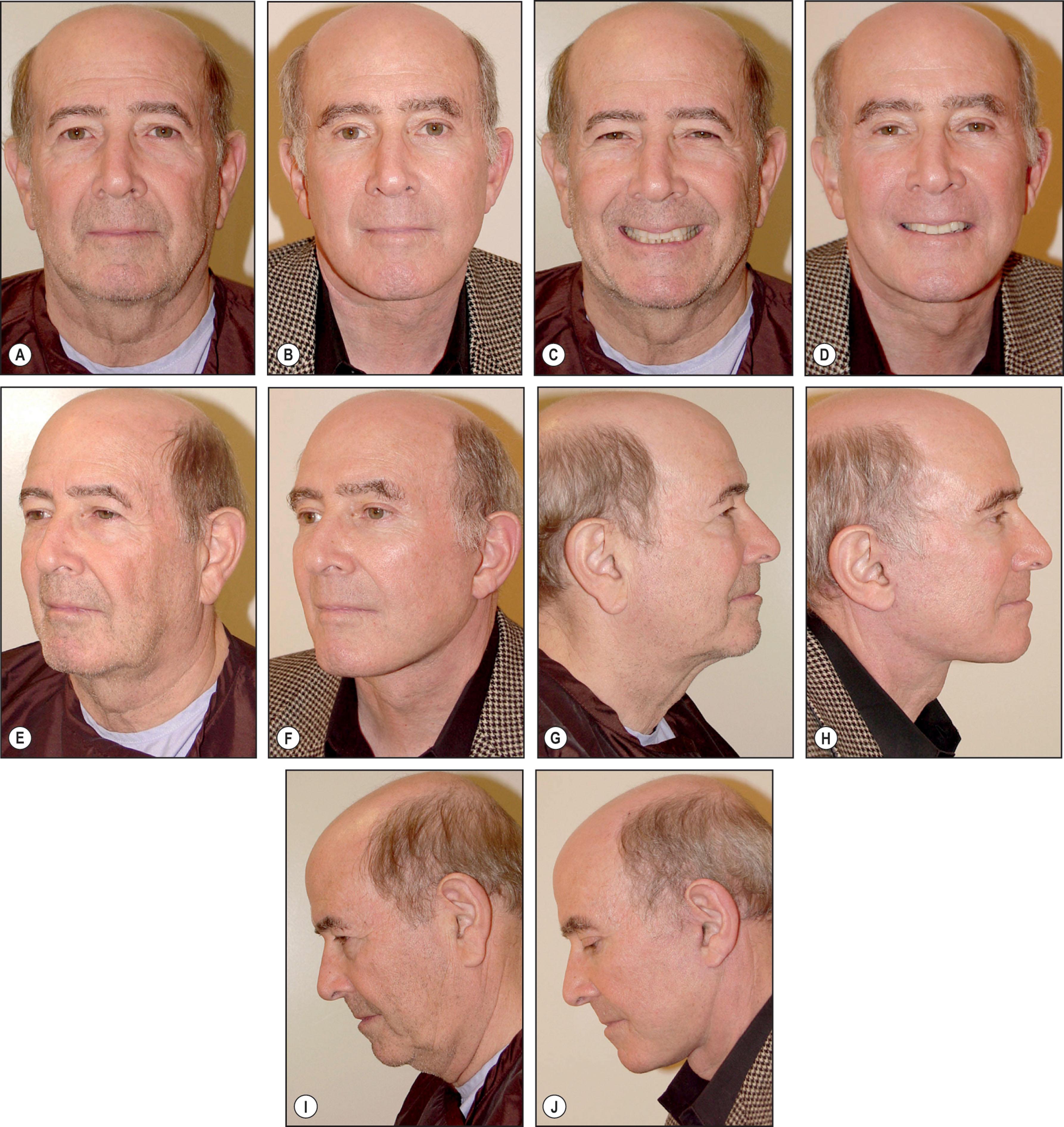 Figure 9.11.39, Patient example 3. (A) Front view; before surgery view of patient, age 68. The patient has eyebrow ptosis, full upper eyelids, sagging cheeks, deep cheek folds, and jowls. Loss of youthful facial contour can be seen in the cheek and jowl areas. (B) Front view; same patient, 1 year and 9 months after facelift, necklift , small incision forehead lift, upper and lower eye lifts, partial facial fat grafting and earlobe reduction. Note improved eyebrow position and configuration, corrections of hooded eyelids, diminished cheek folds, elimination of jowls, and restoration of youthful and masculine facial shape without a tight or pulled appearance. (C) Front smiling view; before surgery view of patient, age 68. Note suboptimal upper dental show and tired and disinterested appearance despite broad smile. (D) Front smiling view; same patient, 1 year and 9 months after facelift, necklift , small incision forehead lift, upper and lower eye lifts, partial facial fat grafting and earlobe reduction. Note alert and composed appearance and fit, masculine-appearing jawline. A more natural smile with improved dental show is also seen. (E) Oblique view; before surgery view of patient, age 68. Note drooping eyebrow, hooded upper eyelid, sagging cheek and overall loss of youthful facial contour. There is little if any transition from the lower cheek to the neck, and a poor jawline is present. (F) Oblique view; same patient, 1 year and 9 months after facelift, necklift , closed forehead lift, upper and lower eye lifts, partial facial fat grafting and earlobe reduction. Note eyebrow position and configuration, restoration of cheek fullness, diminished cheek (nasolabial) fold, bold masculine jawline, and improved neck contour. The patient has a rested, fit, decisive, virile and masculine appearance. An improved transition from the lower cheek to the neck is evident. (G) Lateral view; before surgery view of patient, age 68. Note lower eyelid fullness, sagging cheek, poor jawline, heavy jowl, and neck laxity. (H) Lateral view; same patient, 1 year and 9 months after facelift, necklift , closed forehead lift, upper and lower eye lifts, partial facial fat grafting, and earlobe reduction. An improved transition from the lower eyelid to the upper cheek can be seen, the cheek position has been improved, and a fit, masculine-appearing jawline and neckline is evident. The face has a natural appearance and all scars are well concealed. Note also that the earlobe has been subtly reduced, adding to an overall more youthful appearance. (I) Lateral view, looking down; before surgery view of patient, age 68. Note poor neckline when looking down. (J) Lateral view, looking down; same patient, 1 year and 9 months after facelift, necklift , closed forehead lift, upper and lower eye lifts, minor partial facial fat transfer, and earlobe reduction. Note improved neck contour in the flexed position. The face has a natural appearance and all scars are well concealed. All surgical procedures performed by Timothy Marten, MD, FACS.