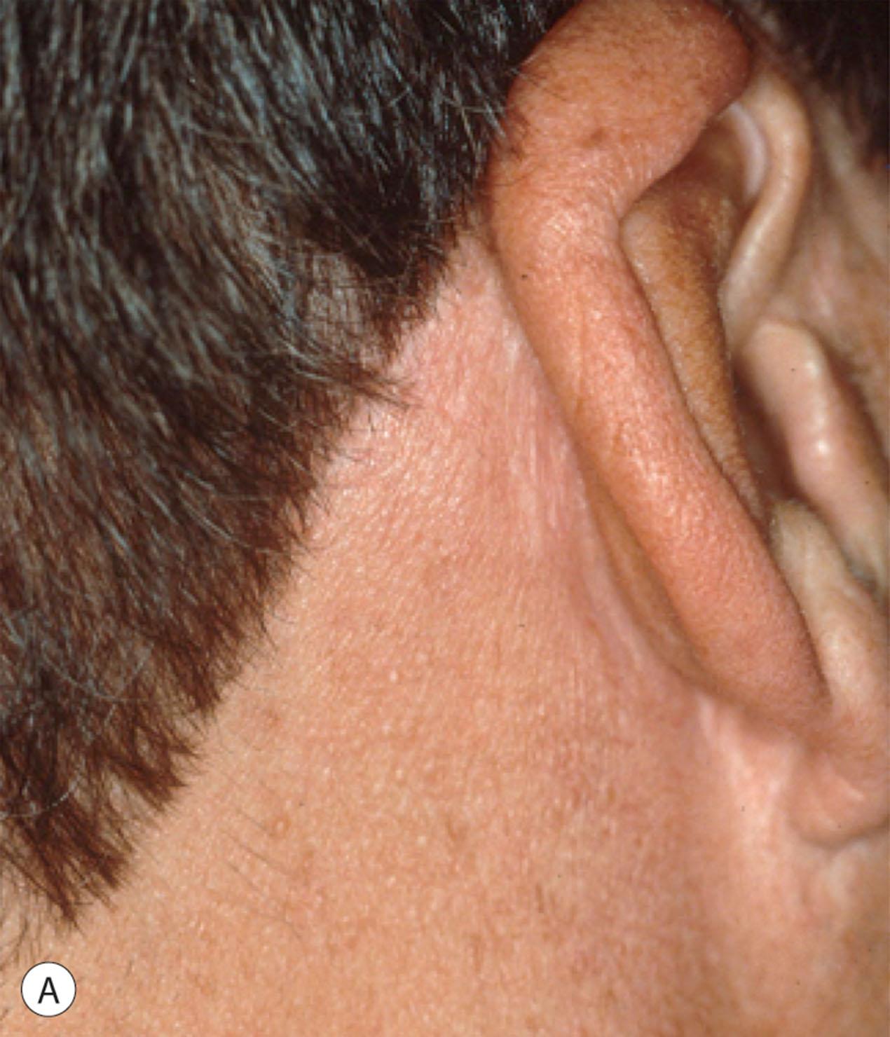 Figure 9.11.2, (A,B) Occipital hairline scar in men with short hair. The bald man or the man with short hair, while often regarded by some as a significant challenge above and beyond that of the typical patient, can be treated in the same way as a man or woman with abundant hair. Even sparse, short hair provides good cover for the temple and occipital scars if properly planned as the short hair worn by most men falls over the scars and conceals them. This is the case even in the man who wears a “military-style” haircut. All surgical procedures performed by Timothy Marten, MD, FACS.