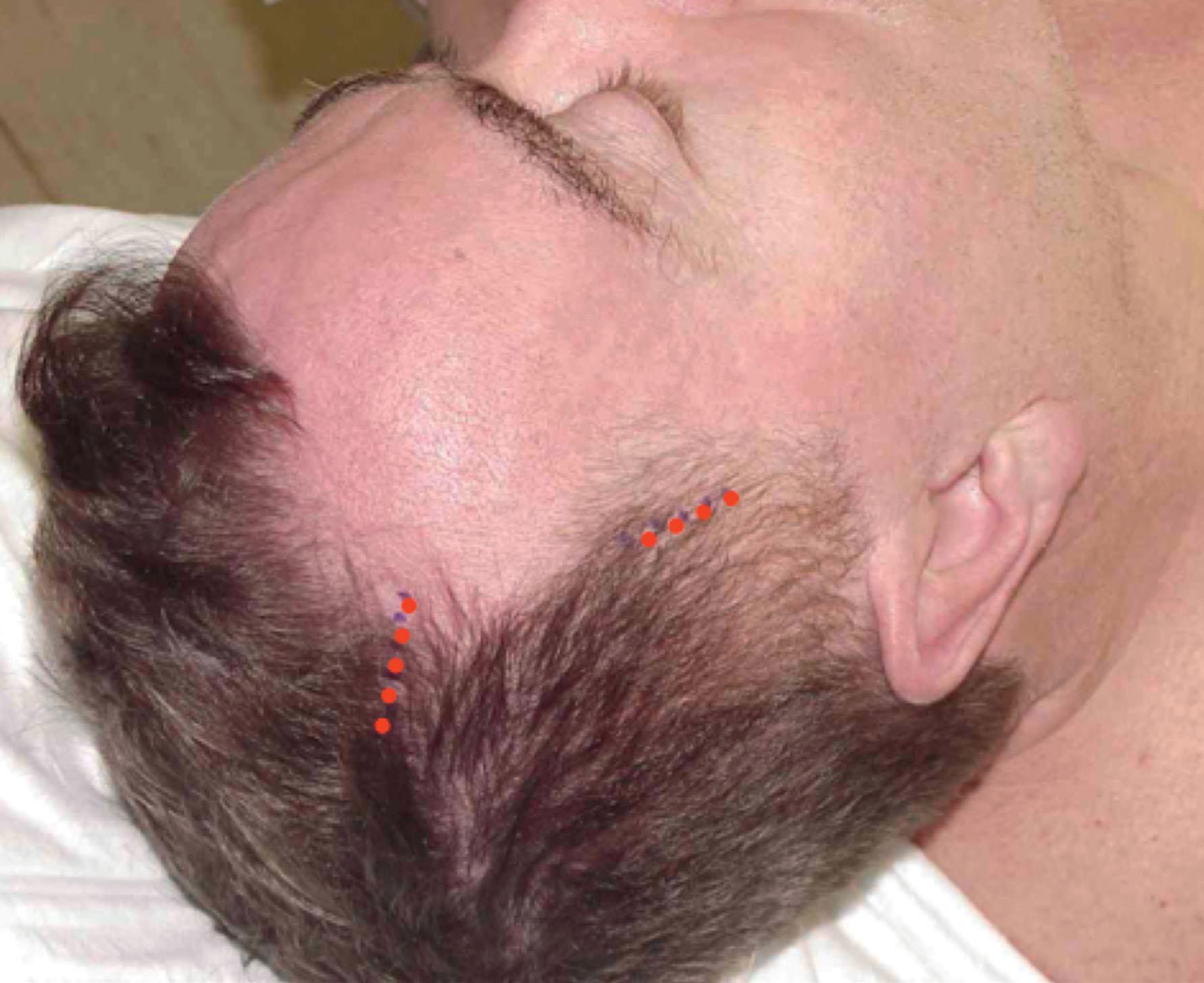 Figure 9.11.26, “Small incision” temple and forehead lift. Most men need conservative treatment of their forehead and brow and are well served with a “sort scar” small incision plan as shown. The incision on the temporal scalp is used to make a subgaleal dissection and the incision on the parietal scalp is used to make a subperiosteal dissection. A lateral forehead flap can be mobilized and elevated by subsequently releasing the temporal line of adherence between the two planes and dividing the periosteum under the lateral aspect of the eyebrow. An endoscope is not required and the latter maneuvers can be accomplished under direct vision through the incision on the temporal scalp.