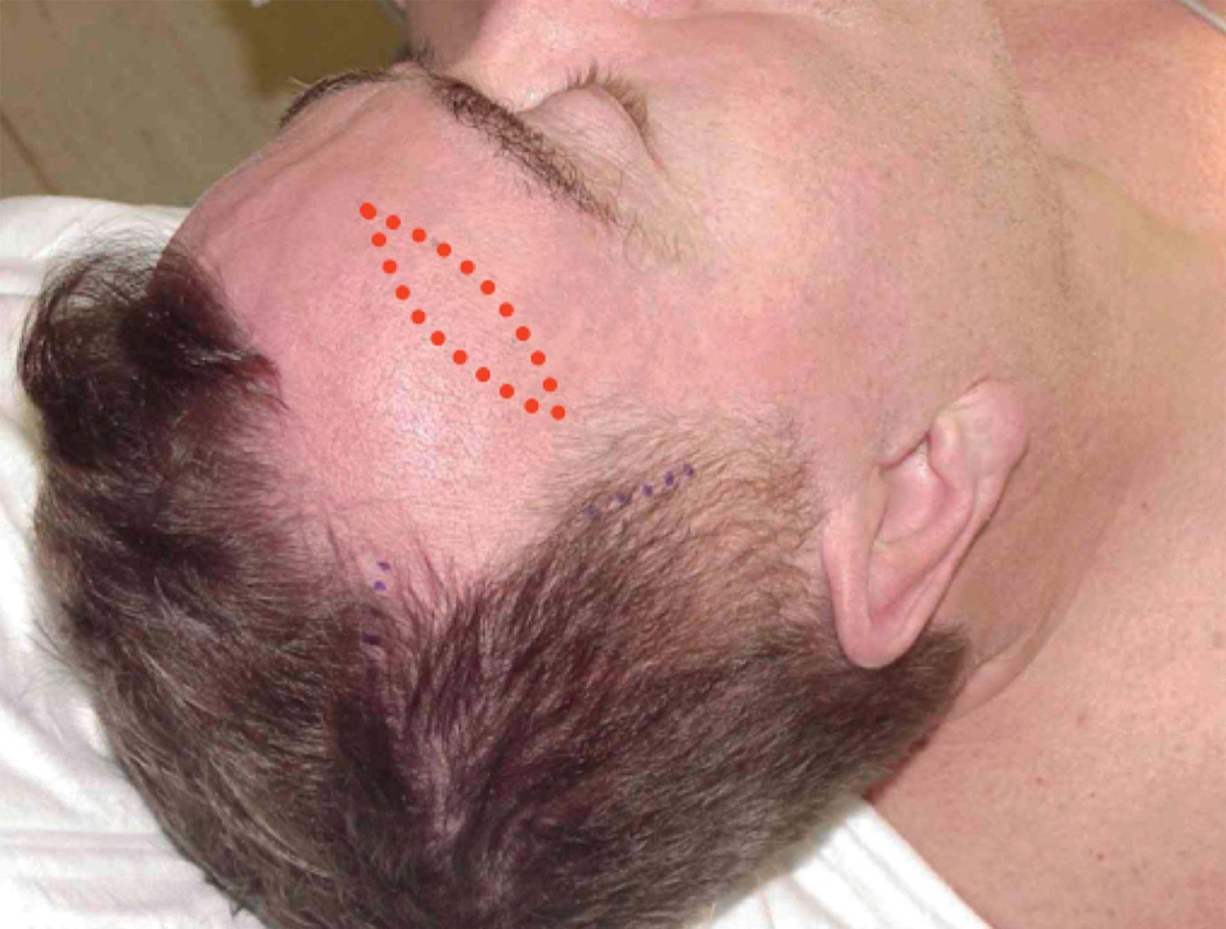 Figure 9.11.28, Forehead crease temple-forehead lift incision plan. Bald or balding men, men who wear very short hairstyles, men who have previously had hair transplants and fear disruption of their hairline, and men with shaved heads can be effectively treated using an incision in a horizontal forehead crease. Skin only is excised and minimum undermining only is usually required. The scar once healed is often less conspicuous than the forehead crease it was planned around if meticulously closed under no tension. Unlike a “superciliary” “direct” eyebrow lift (see Fig. 9.11.29 ) this plan allows lifting of the temporal face as well as the eyebrow, and reduction of temporal redundancy that is sometimes generated by a facelift procedure.