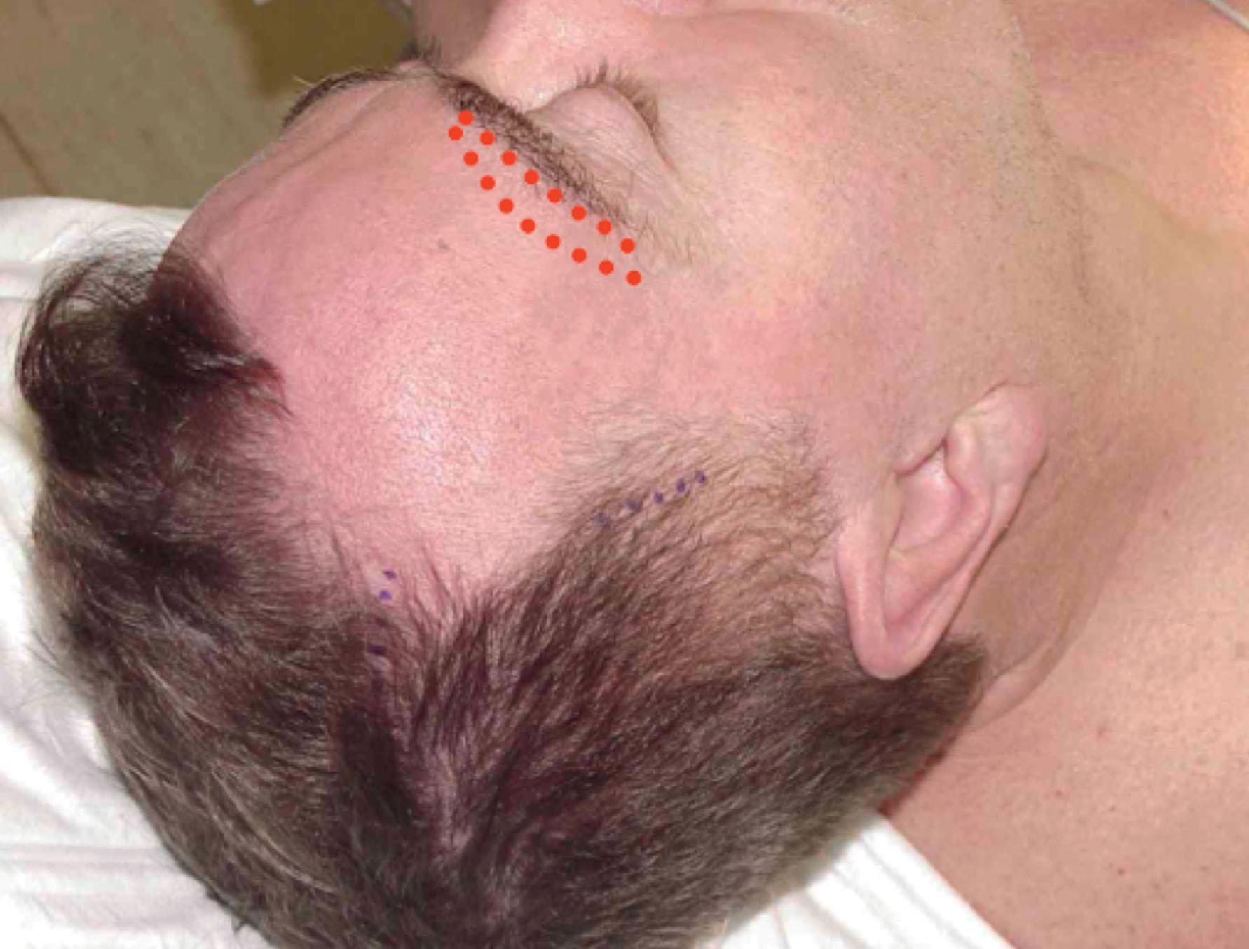 Figure 9.11.29, Superciliary “direct” eyebrow lift incision plan. Bald or balding men, men who wear very short hairstyles, men who have previously had hair transplants and fear disruption of their hairline, and men with shaved heads can be effectively treated using and incision along the upper margin of the eyebrow. Skin only is excised and minimum undermining only is usually required. The scar once healed is typically inconspicuous, especially in men in the facelift age group. This plan does not allow lifting of the temporal face as and is not helpful in reducing temporal redundancy that is sometimes generated by a facelift procedure.