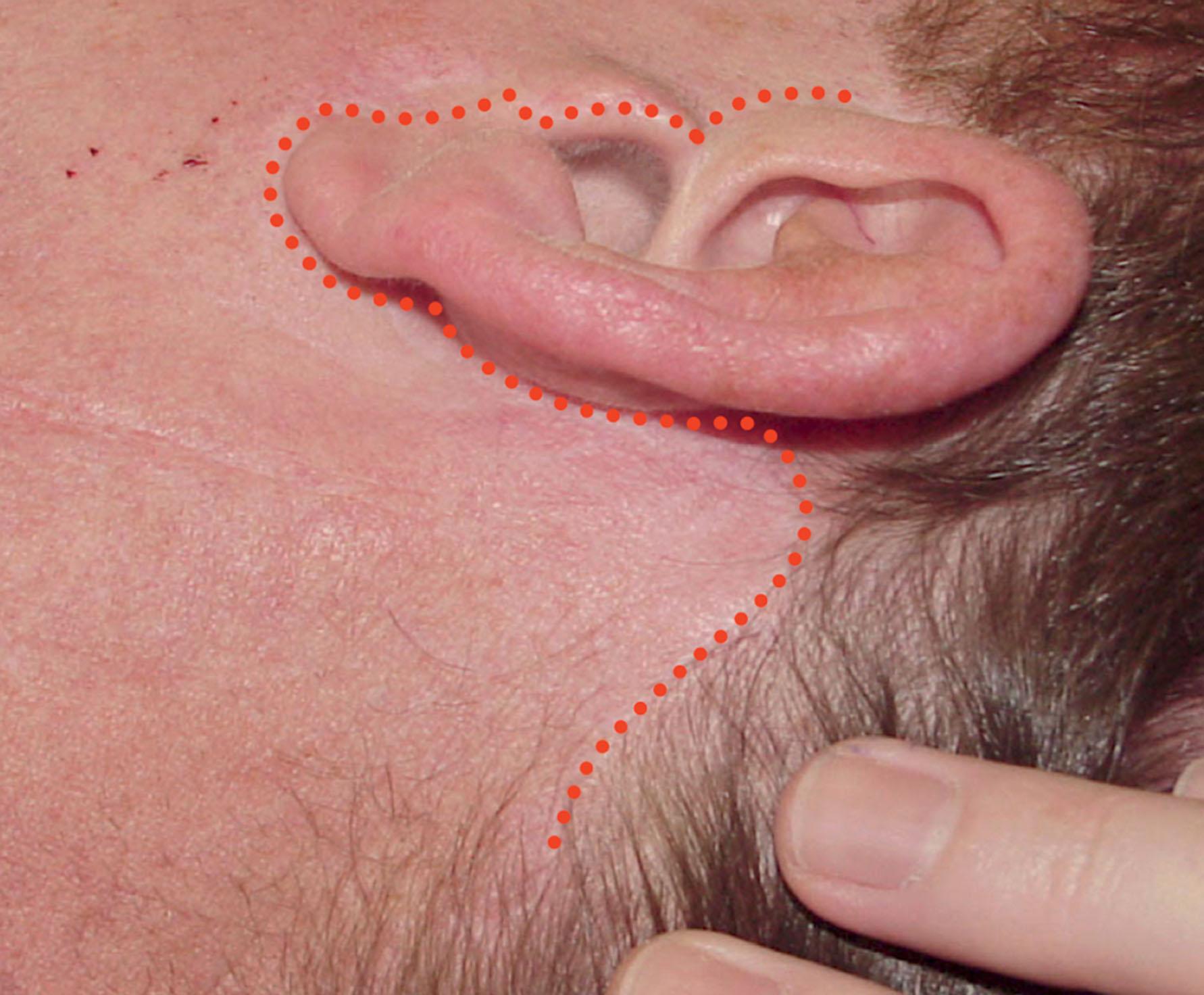Figure 9.11.5, Extended necklift incision plan. The incision plan for an “extended necklift” is similar to the typical periauricular facelift incision plan without the temporal portion of the incision. This incision plan allows some lower facial skin to be excised and a “low” superficial musculo-aponeurotic system (SMAS) flap to be elevated and advanced (or low SMAS plication or SMAS stacking to be performed) that provides improvement in the lower face and along the jawline that would not otherwise be obtained if an isolated necklift (short scar necklift) only was performed.