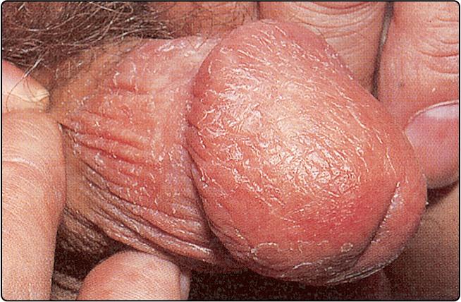 Fig. 72.1, Eczema of the glans penis.