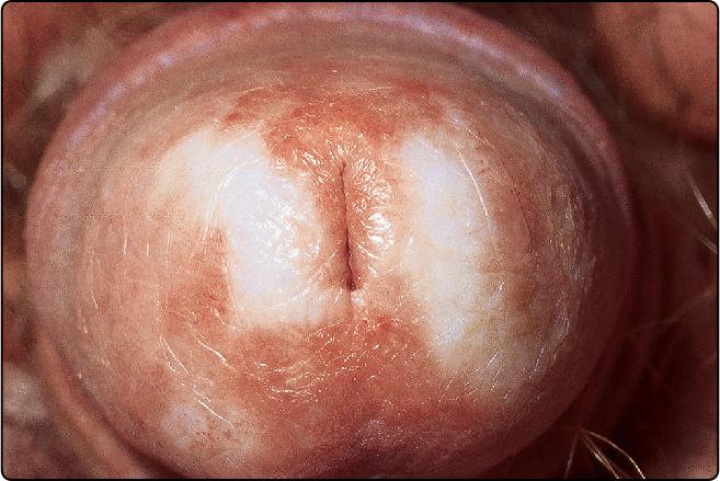 Fig. 72.2, Lichen sclerosus.