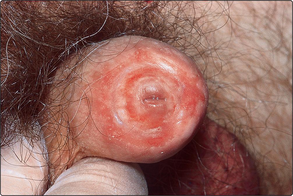 Fig. 72.3, Lichen sclerosus showing inflammation and phimosis.