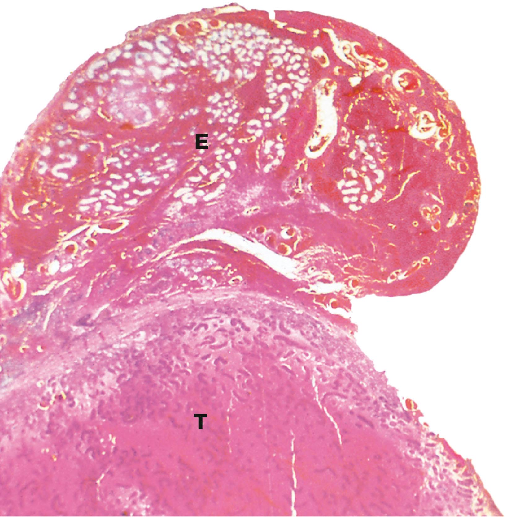 e-Fig. 18.1, Torsion of the testis (LP)