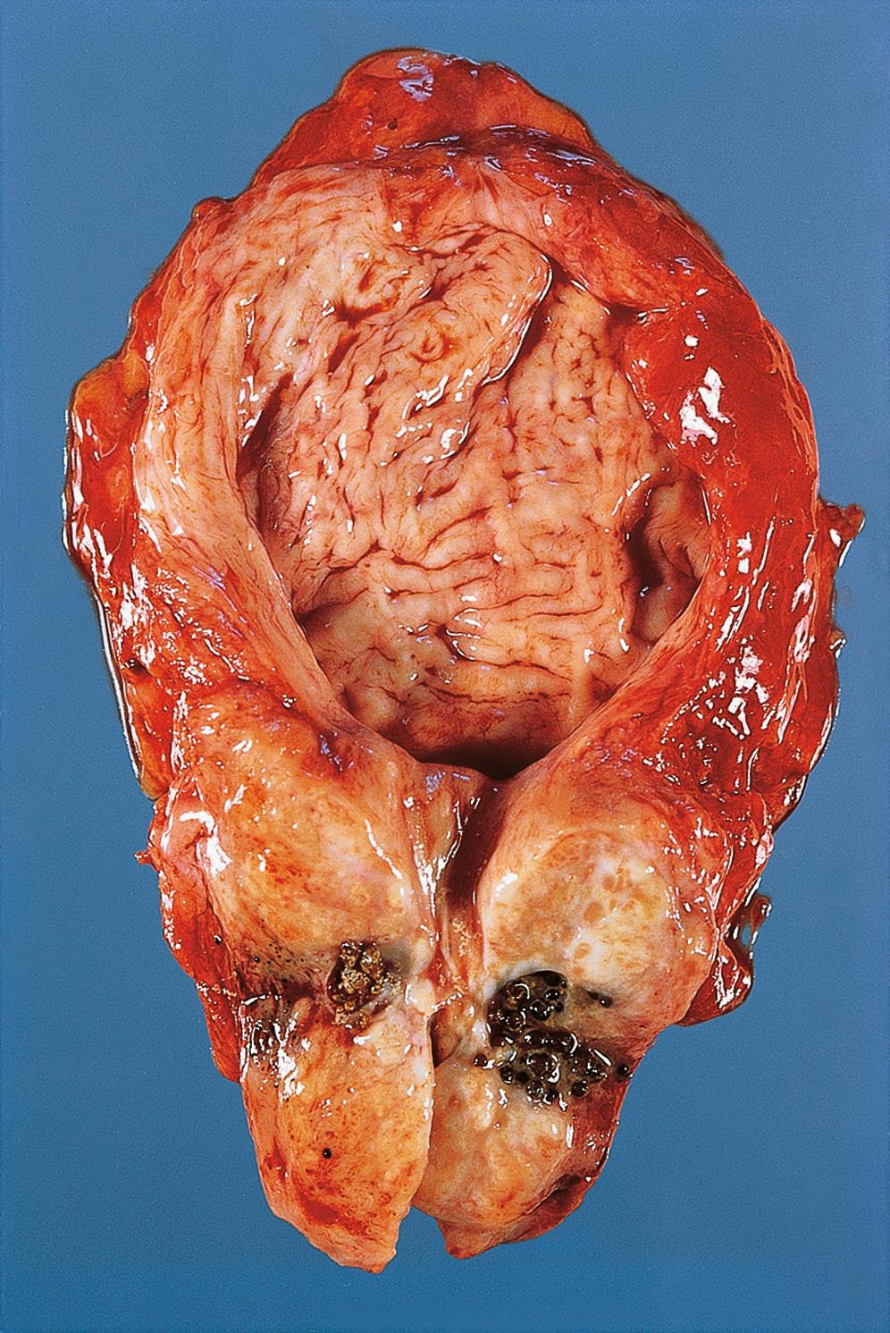 E-Fig. 19.6 G, Benign prostatic hypertrophy (BPH). The prostate is enlarged due to nodular hyperplasia of both the glands and stroma, usually within the periurethral zone. This results in urinary outflow obstruction and urine retention within the bladder. As a result, the bladder wall becomes thickened due to detrusor muscle hypertrophy and the lining of the bladder becomes trabeculated.