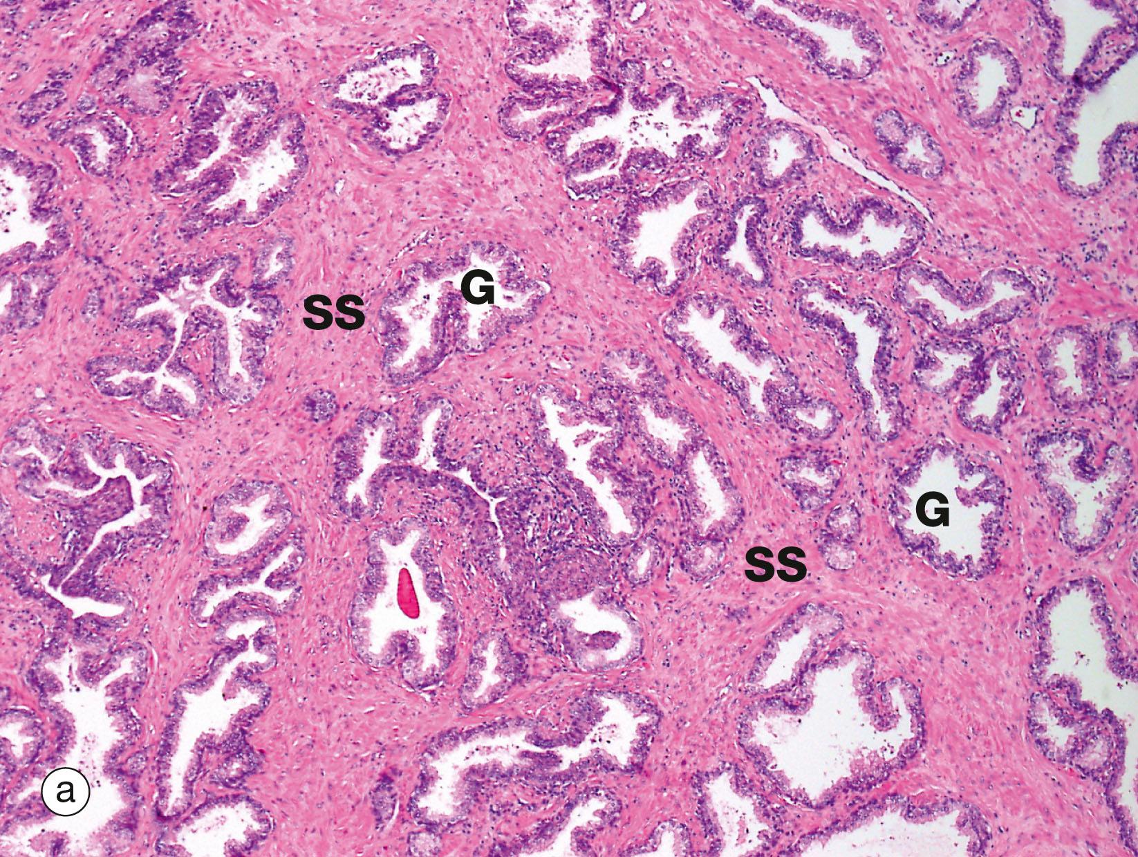 Fig. 18.19, Prostate gland