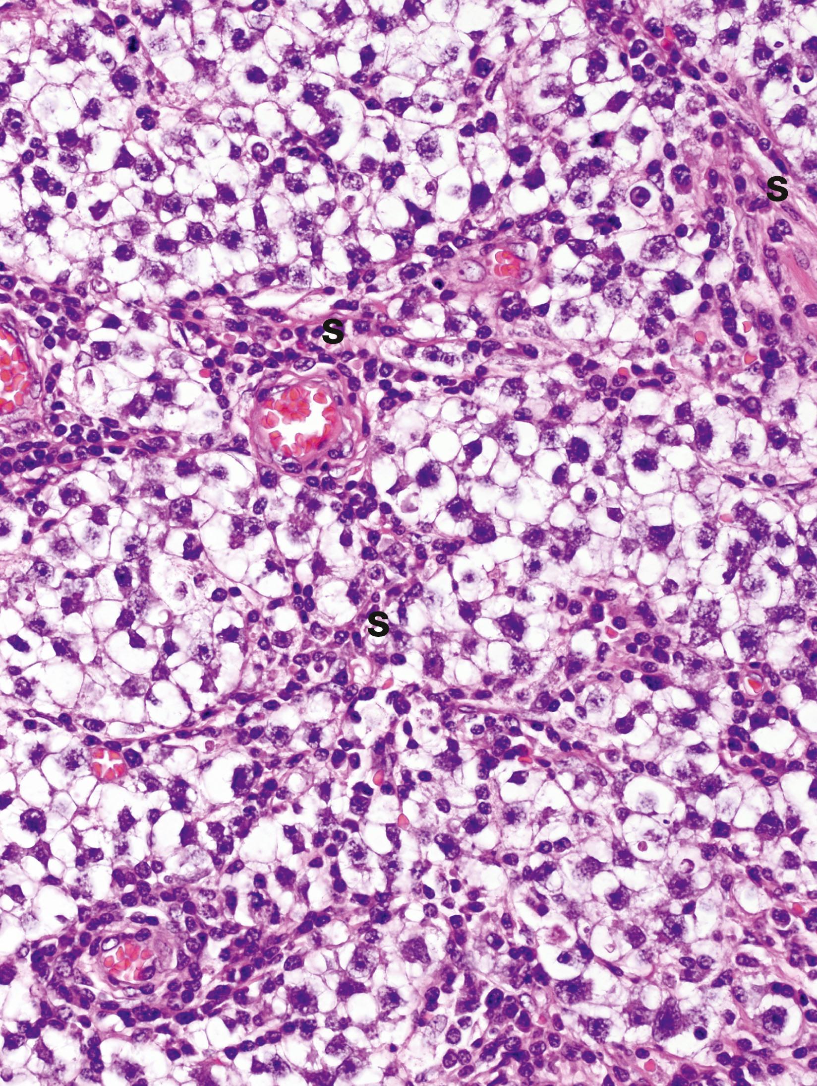 E-Fig. 18.2, Classical seminoma (HP)